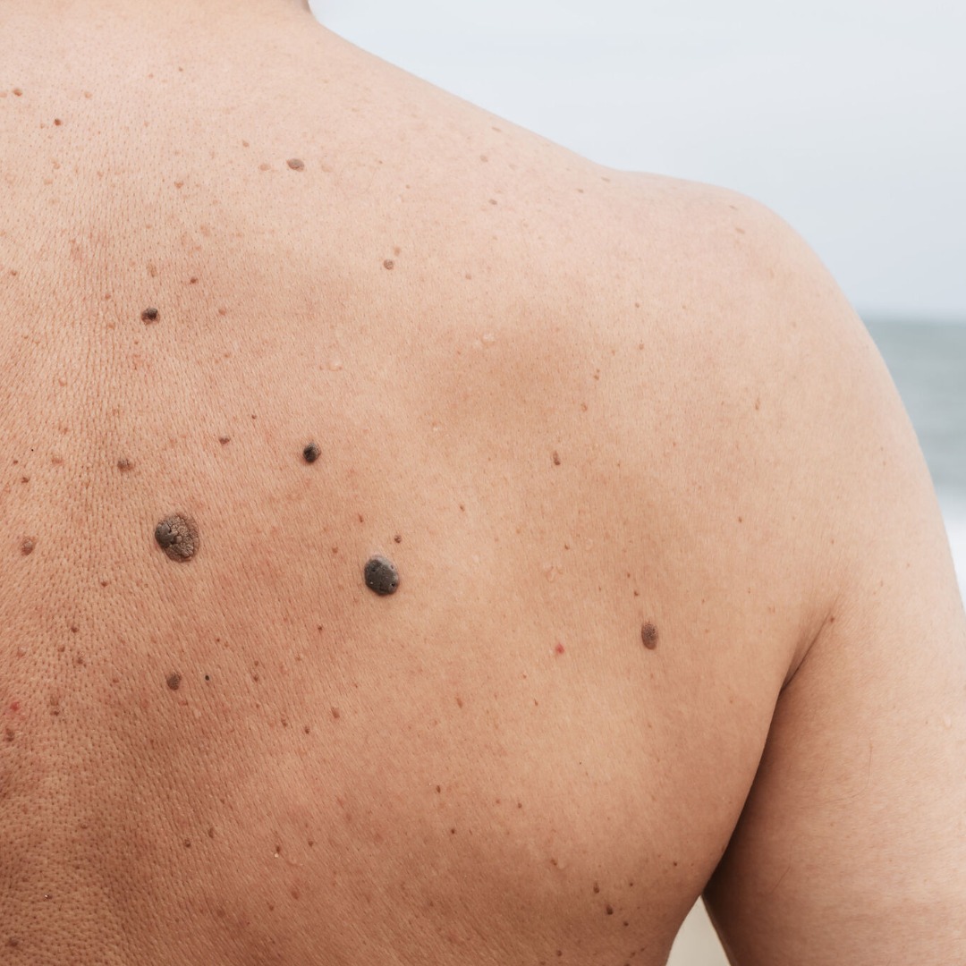 Introducing, the newest addition to our website - a dedicated page to mole & blemish removal, and Map My Mole!
You may have noticed we've been talking a lot about moles and blemishes recently. Whilst we've always been passionate about this, the introduction of Map My Mole and Larissa's recent experiences with a cancerous blemish has made us more determined than ever to help others spot and address skin concerns.
Learn everything you need to know about mole removal, changes to look out for, how we remove or reduce moles & blemishes, and how Map My Mole works.
Head to the link in our bio to explore our comprehensive guide to mole and blemish removal, and don't hesitate to get in touch if you have a blemish you'd like to get checked out!