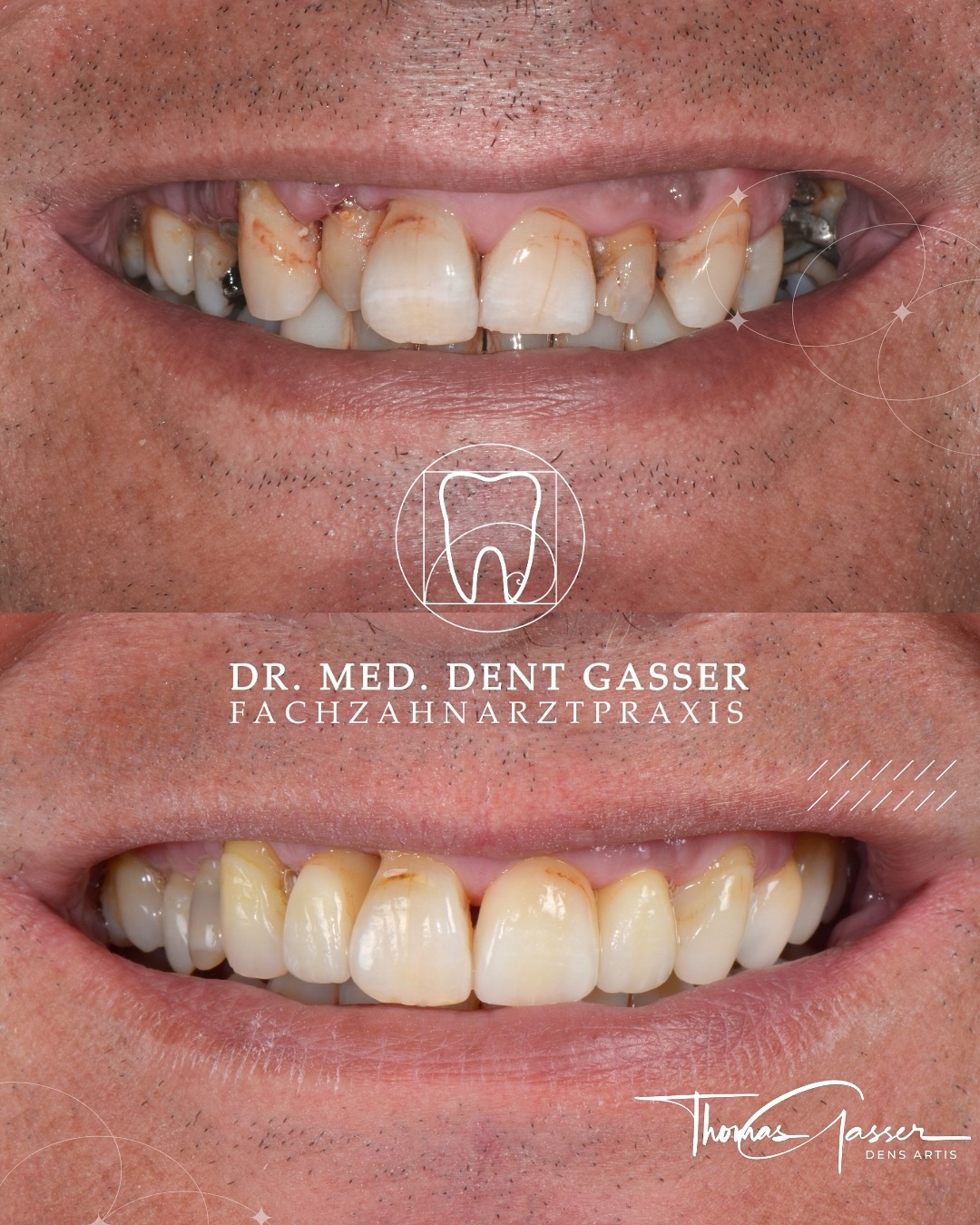 Natürliche Ästhetik durch gezielte Korrektur
Dieses Vorher-Nachher-Beispiel zeigt eine ästhetische Teilkorrektur, bei der gezielt nur einzelne Zähne behandelt wurden. Mit hochwertigen Veneers und vollkeramischen Kronen konnten Form und Farbe dezent optimiert werden – exakt abgestimmt auf die natürlichen Nachbarzähne.
Ergänzend erfolgte eine chirurgische Zahnfleischmodellierung, um die Symmetrie im Frontzahnbereich zu verbessern und die Harmonie zwischen Zahn und Zahnfleisch sanft auszugleichen.
Das Ergebnis ist ein natürlich wirkendes, harmonisches Lächeln, das die Persönlichkeit des Patienten bewahrt – ästhetisch, funktional und individuell.
Der Patient ist mit dem Ergebnis sehr zufrieden.
Behandlungsschritte im Überblick:
- Präzise Planung der Teilkorrektur
- Veneers und Kronen aus hochwertiger Keramik
- Zahnfleischkorrektur für ästhetische Harmonie
- Individualisierte Farbabstimmung mit dem Gesamtzahnbild
📍 Fachzahnarztpraxis Dr. Thomas Gasser
Greifengasse 1, 4058 Basel
📞 Telefon: +41 61 681 00 10
📧 E-Mail: fachzahnarztpraxis_basel@sso-hin.ch
🌐 Website: www.densartis.ch
🦷 Unsere Leistungen auf einen Blick:
• Ästhetische Zahnmedizin (Bleaching, Veneers, vollkeramische Restaurationen)
• Implantologie
• Parodontalbehandlung
• Prothetik (Zahnersatz)
• Mikrochirurgie
• Prophylaxe & Dentalhygiene
• Funktionstherapie (z. B. bei Knirschen)
#ZahnarztBasel #GesundesLächeln #BaslerZahnarzt #Basel #BaselSwitzerland #Schweiz #Baselstadt #BaselLiebe #Zahnmedizin #Zahnarztpraxis #Zahngesundheit #Implantologie #Zahnersatz #Prophylaxe #ÄsthetischeZahnmedizin #MittlereBrücke #Straumann #DrThomasGasser #ZahnarztImplantate #Lächeln #GesundeZähne #ZahnmedizinMitHerz #ZahnarztpraxisBasel #Zahngesundheit