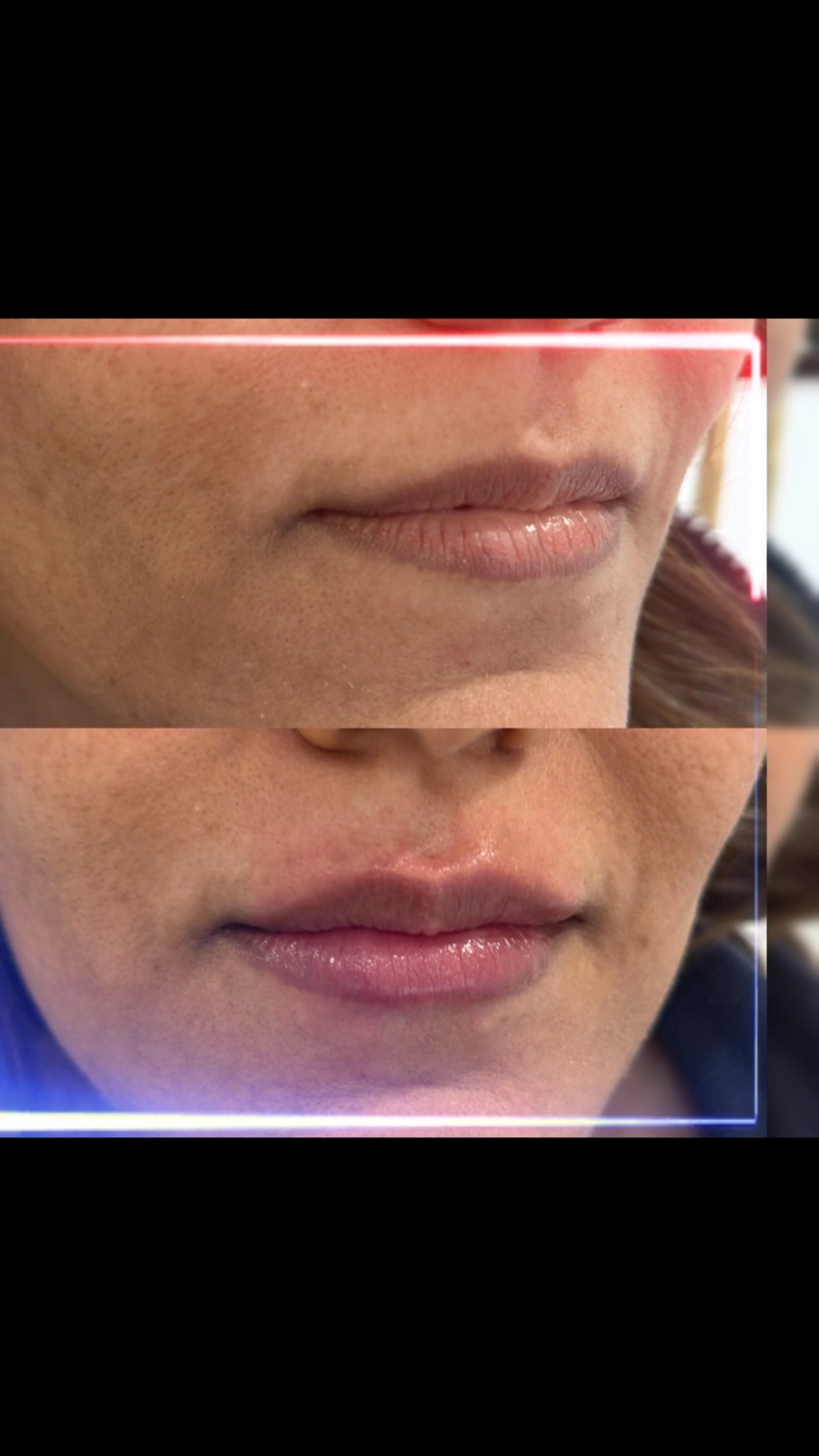 A beautiful juicy refresh for our lovely client. Simple. Tasteful. Most of all - not plastic. Pictures taken immediately after. Get yourselves summer ready!
Contact us for more information.
#hoppyeaster #lips #plump #kissme #kisskiss #juicy
@enalionbeauty
@newenergyfitness
@simplyskinltd