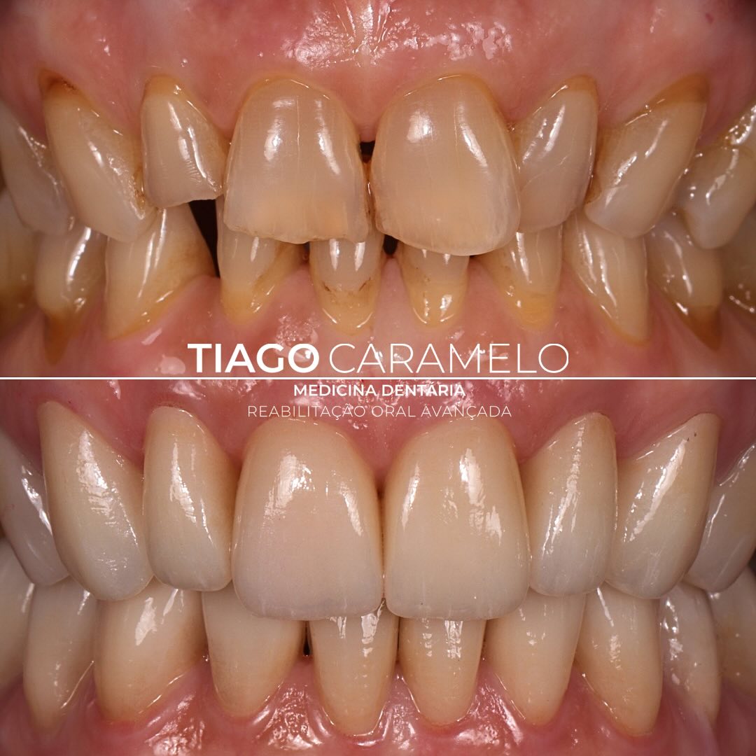 Estas três fotografias ampliadas mostram diferentes perspetivas de um único caso clínico de desgaste dentário severo, transformado com recurso a facetas e coroas cerâmicas.
Através da ampliação, conseguimos valorizar todos os pormenores de uma reabilitação oral avançada: desde as alterações estéticas, ao contorno gengival, à forma, cor e textura dos dentes.
Mais do que uma mudança visível, é uma reabilitação pensada ao detalhe — onde a estética se alia à função, devolvendo confiança e naturalidade ao sorriso.
Reabilitação Oral Avançada é precisão, dedicação e atenção a cada pormenor.
Trabalho laboratorial realizado por @daniela_cardoso7
—————————————————————————————
These three close-up photographs show different perspectives of a single clinical case of severe dental wear, transformed through the use of ceramic veneers and crowns.
Through magnification, we are able to appreciate every detail of advanced oral rehabilitation — from aesthetic changes to gingival contour, and the shape, color, and texture of the teeth.
More than a visible transformation, it is a rehabilitation carefully crafted in every detail — where aesthetics and function come together to restore confidence and a natural smile.
Advanced Oral Rehabilitation is precision, dedication, and attention to every detail.
Labwork by @daniela_cardoso7
#oralrehabilitation #ceramicveneers #ceramiccrowns #beforeandafter #reabilitaçãooralavançada