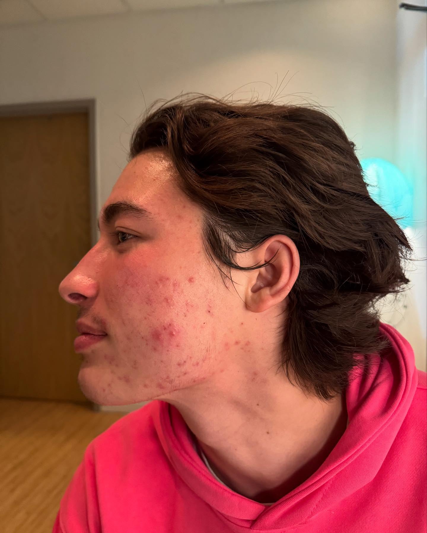 Look at this amazing transformation with @kaikunz14 Kai calls me his “ Skin Coach” The protocol Circadia Lactic Acid peel 30% progressing to 45% every 4 weeks for 3 months!!
Strict take home care Circadia Mandelic acid cleanser and Circadia Daytime Control moisturizer #circadiapeels #circadia #acnetreatment #acneproneskin #acnefighter#skincoach