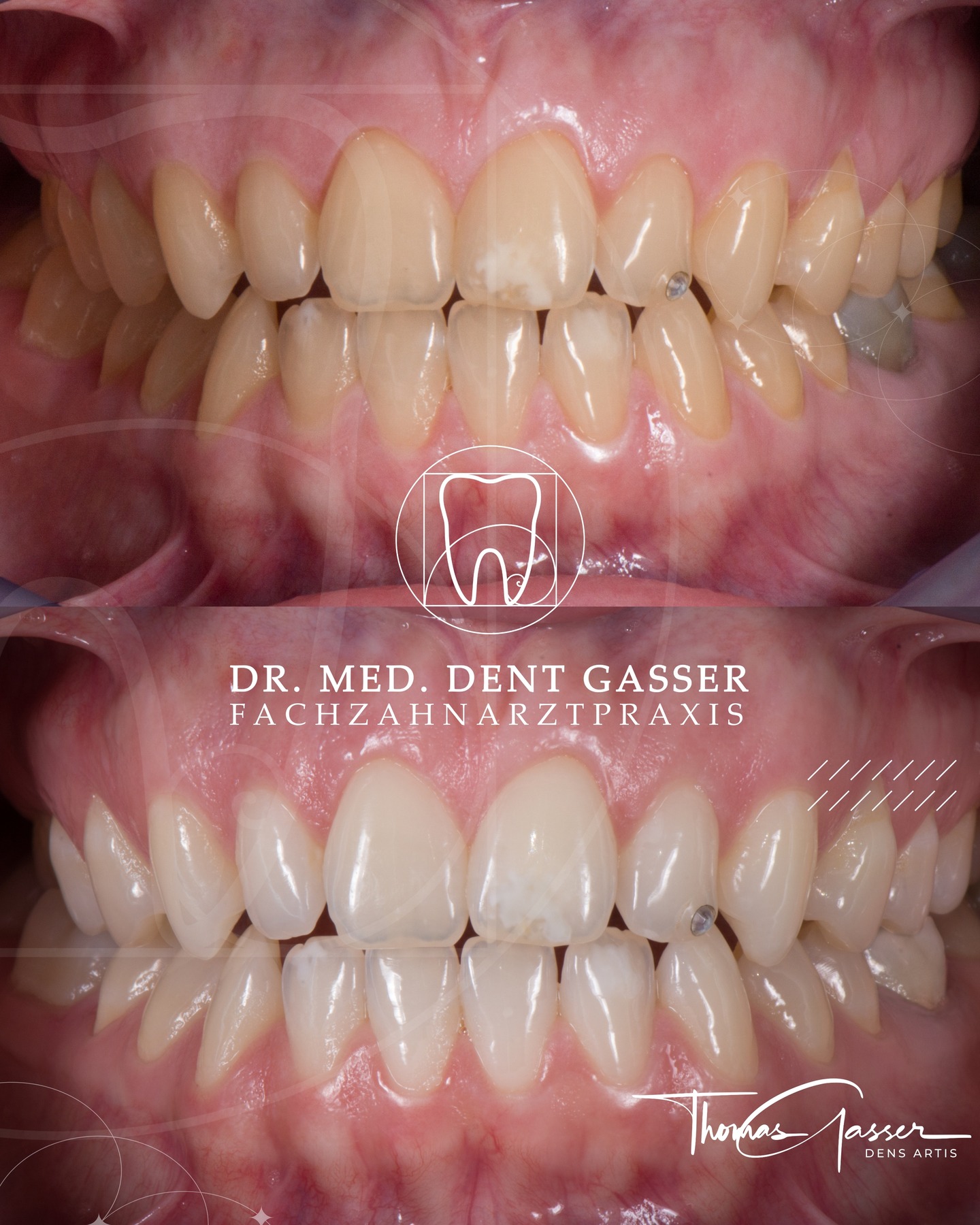 ✨ Strahlender, frischer – aber ganz du selbst
Dieses Vorher-Nachher zeigt, was ein professionelles Inhouse-Bleaching bewirken kann:
In nur 90 Minuten wurde die Zahnfarbe sichtbar aufgehellt – schnell, sicher und schonend für den Zahnschmelz.
Das Bleaching-Gel wird gezielt aufgetragen und durch Licht aktiviert – für eine gleichmäßige, kontrollierte Aufhellung.
Die Zähne wirken frischer, das Lächeln lebendiger – ohne künstlich zu wirken.
⚠️ Wichtig zu wissen:
Kurzfristige Empfindlichkeiten können auftreten, sind aber meist harmlos und schnell wieder verschwunden.
Das Ergebnis: ein natürliches, strahlendes Lächeln, das zu dir passt.
🔍 Bleaching auf einen Blick:
✔️ Professionell in der Praxis
✔️ Ergebnis in einer Sitzung (ca. 90 Min)
✔️ Schonend für Zahnschmelz & Zahnfleisch
✔️ Keine langfristigen Nebenwirkungen bei geeigneter Indikation
📍 Fachzahnarztpraxis Dr. Thomas Gasser
Greifengasse 1, 4058 Basel
📞 Telefon: +41 61 681 00 10
📧 E-Mail: fachzahnarztpraxis_basel@sso-hin.ch
🌐 Website: www.densartis.ch
🦷 Unsere Leistungen auf einen Blick:
• Ästhetische Zahnmedizin (Bleaching, Veneers, vollkeramische Restaurationen)
• Implantologie
• Parodontalbehandlung
• Prothetik (Zahnersatz)
• Mikrochirurgie
• Prophylaxe & Dentalhygiene
• Funktionstherapie (z. B. bei Knirschen)
📍**#ZahnarztBasel #GesundesLächeln #BaslerZahnarzt #Basel #BaselSwitzerland #Schweiz #Baselstadt #BaselLiebe #Zahnmedizin #Zahnarztpraxis #Zahngesundheit #Implantologie #Zahnersatz #Prophylaxe #ÄsthetischeZahnmedizin #MittlereBrücke #Straumann #DrThomasGasser #ZahnarztImplantate #Lächeln #GesundeZähne #ZahnmedizinMitHerz #ZahnarztpraxisBasel #Zahngesundheit**