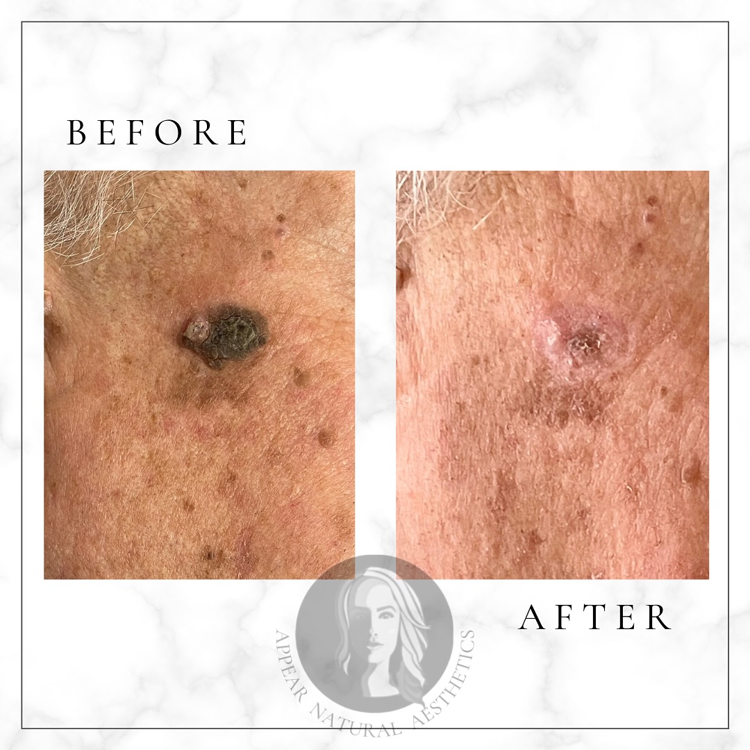 .
Satisfaction ð¯
One session of ðð¿ððŒððµð²ð¿ð®ðœð & this Seborrheic Keratosis didnât stand a chance. After years of living with it my client is so happy to finally see the back of it!
The âafterâ photo was taken a few weeks post treatment therefore the skin is still in the healing stages & will continue to improve over the coming weeks.
ðð¿ððŒððµð²ð¿ð®ðœð is a pain free, quick & affordable solution to treat unwanted skin lesions such as;
âïžCherry Angiomas
âïžAge Spots
âïžSeborrheic Keratosis
âïžSkin Tags
âïžWarts
Get in touch to find out more.
ðwww.appearnaturalaesthetics.com
ð 07423 109237
ð§ info@appearnaturalaesthetics.com
ð· £70 for initial session, £55 for additional sessions if required
ðHayes, Bromley BR2 7EB