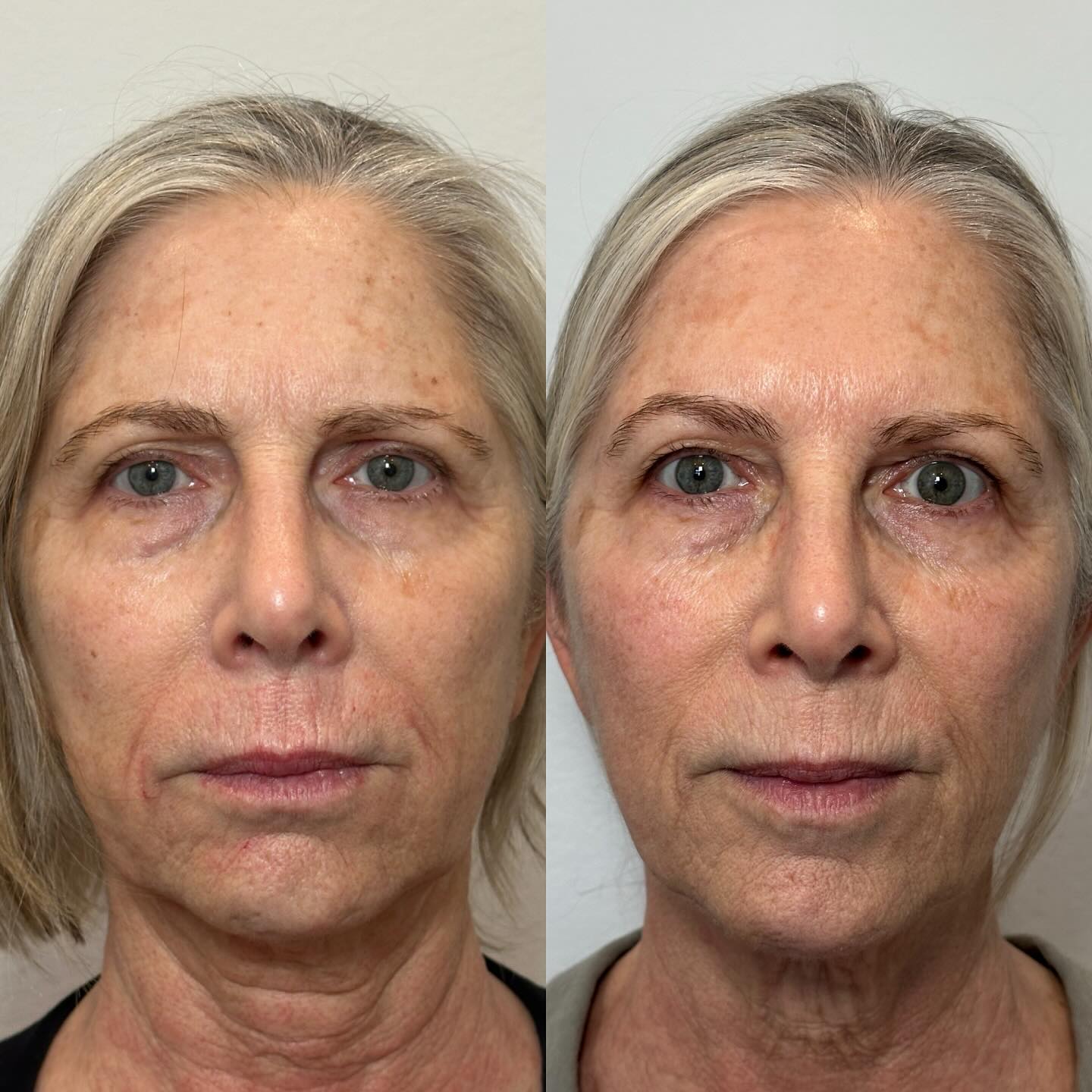 “My vacation is in three weeks, how can I look better before then?” How incredible is it that these results were achieved in one single session?