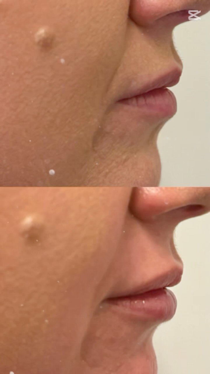 What a Good Friday 🐣
Time to pucker up. A beautiful example of a juicy enhanced lip. Pictures taken immediately after.
#medicallytrained #nurse #injector #prescriber #doctor #dreamteam #hoppyeaster #goodfriday #fridayfeeling #goodvibes #juicy #enhance #rejuvenate #hydrate
@simplyskinltd