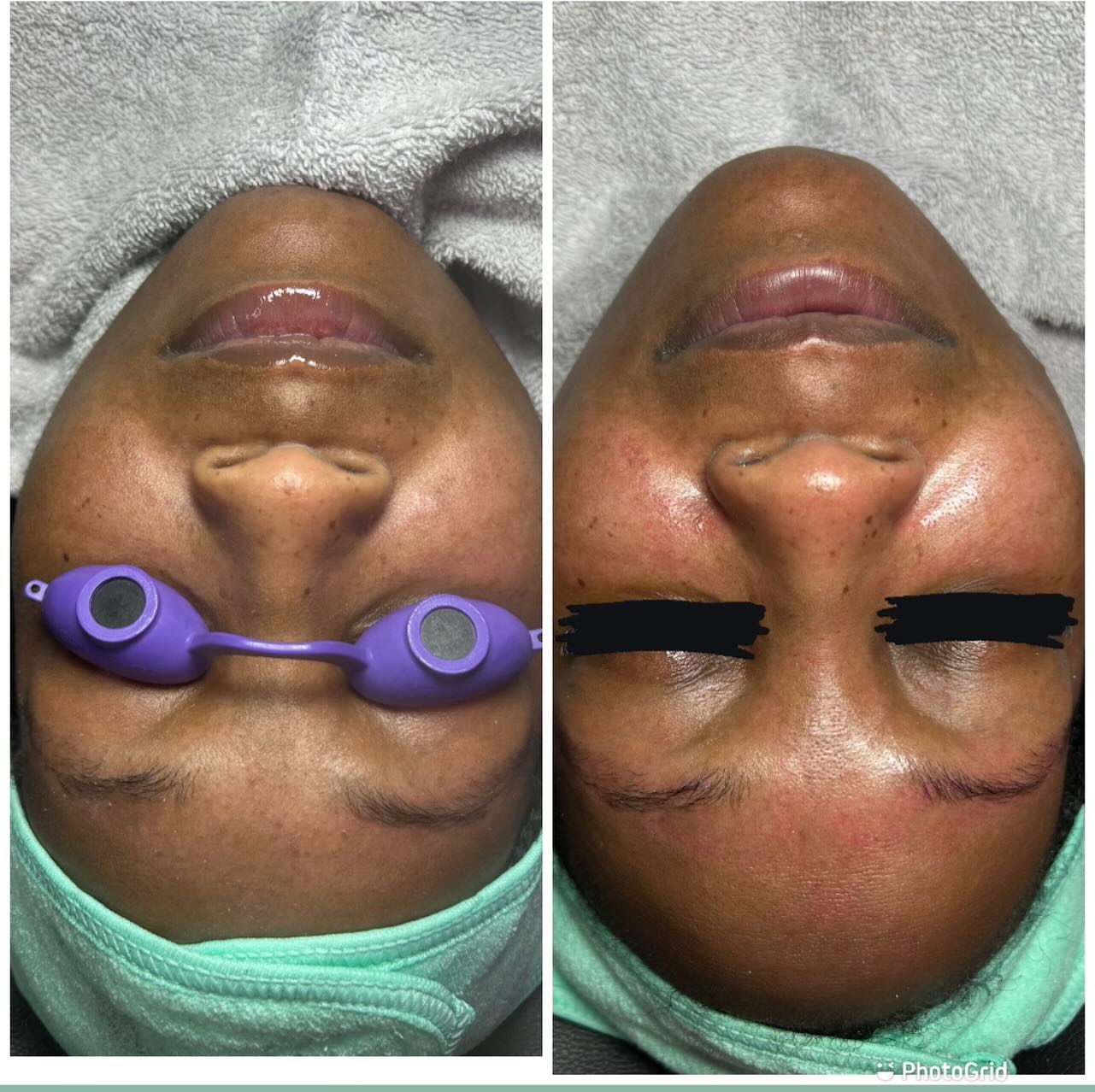 Tired of dry itchy skin? Dead skin on your face?? Did you know with the seasons changing your skin will change as well! Let me help you maintain a natural balance for your skin care.
https://www.aubriafacingit.com/
The seasons is changing & cold-weather is upon us. Remember your skin changes as well. Do your skin seems more dry, irritated, & itchy. Or maybe you see more red and white bumps or your acne or eczema it’s starting to flare up more. Book a session with me and I can help with your every needs. Book here at my website at www.aubriafacingit.com . Look over all my service and see what best fit for you. Hit the chat button online for immediate response.
#dermaplaningfacials #facialatlanta #atlantaspa #atlantaskincare #clearskin #explorepage #vacuumtherapy #facials #lymphaticdrainage #collegeparkga #blackesthetician #eastpointga #Atl #beautiful #facialsatl #spaday #menfacial #dayspa #hairremoval #aesthetics #facialtreatment #blackowned #estheticianatlanta #facingit #extractions #atlanta #naturalskincare #blackheadremoved #atlantastylist #atlantahairstylist