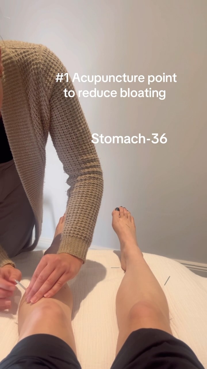 ✨ Acupoint Spotlight: ST-36 (Zusanli) ✨
One of the most powerful points in acupuncture – ST-36 is your go-to for boosting energy, supporting digestion, and calming inflammation.
📍 Location: About four finger widths below the bottom of your kneecap, and just one finger width out from the shin bone. You may feel a tender spot when you press.
🌿 Why I use ST-36 in clinic:
• Tonifies Qi and Blood
• Strengthens digestion (bloating, sluggish bowels, low appetite)
• Boosts immune function
• Regulates menstruation
• Clears damp-heat (great for acne + inflammation)
• Supports energy and recovery
This point is especially helpful when internal imbalances show up on the skin — like breakouts, puffiness, or dullness.
Try gently pressing it daily, or use moxa for warmth and tonification💥
#acupuncture #acupressure #chinesemedicine #tcm #holistichealing #skinhealth #acnetreatment #guthealth #naturalacnetreatment #holisticskincare #acnejourney #naturopathicmedicine #integrativehealth #beautyfromwithin #healthyskin #hormonalacne #glowingskin