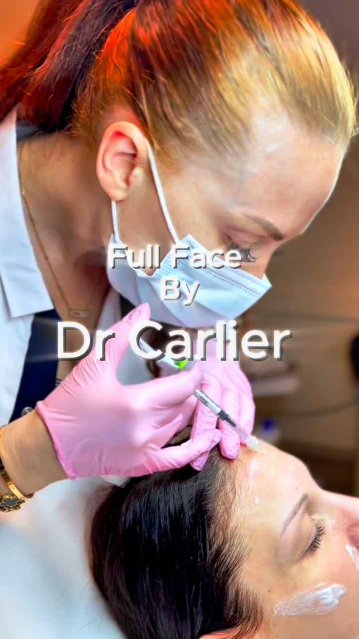 Full face // équilibrage du visage
Chaque visage raconte une histoire. Mon rôle, ce n’est pas de la réécrire, mais de l’écouter… et de l’embellir avec subtilité.
Quand je réalise des injections, je ne cherche pas à transformer un visage, mais à en révéler l’équilibre, à affiner ce qui est déjà là, sans jamais trahir l’identité de la personne en face de moi.
Parce que la vraie beauté, c’est celle qui reste fidèle à vous-même.
Naturelle, assumée, lumineuse.
Ps: les bleus et rougeurs s’estompent et les lèvres peuvent perdent jusqu’à 40% de volume dans les 2 semaines.
#médecineesthétique #injections #harmonieduvisage #rajeunissementfacial #injectionslevres #acidehyaluronique #traitementvisage