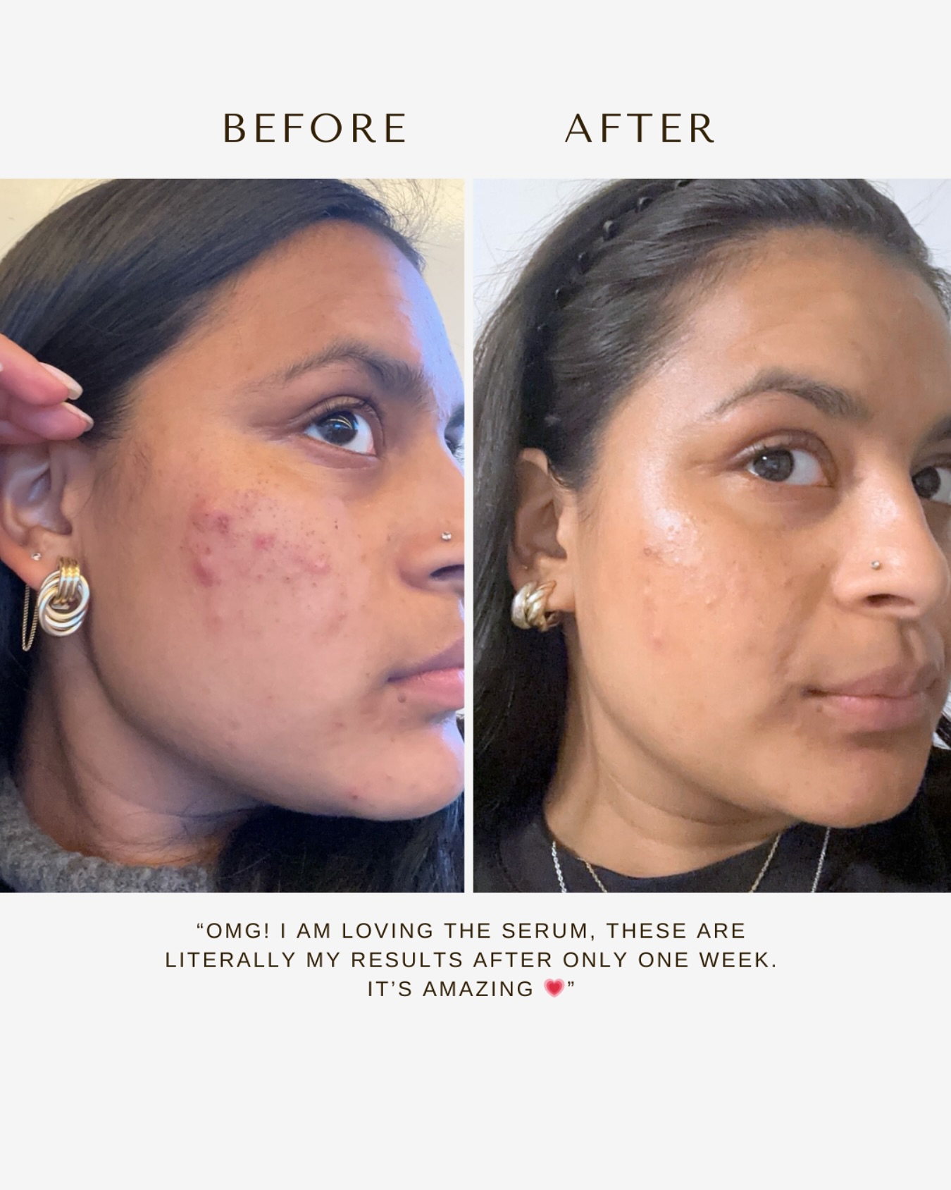 You donât need a 10-step skincare routine or $$$ serums that continuously break the bank.
Just one product. One week. One glow-up.
These results? From one of our Matiki community babes! Real skin, real results.
Powered by plants, not hype. đ
This is your sign to stop overcomplicating your skincare and start feeding it what it actually needs⌠Matico đ
#skingoals #skinacare #naturalskin