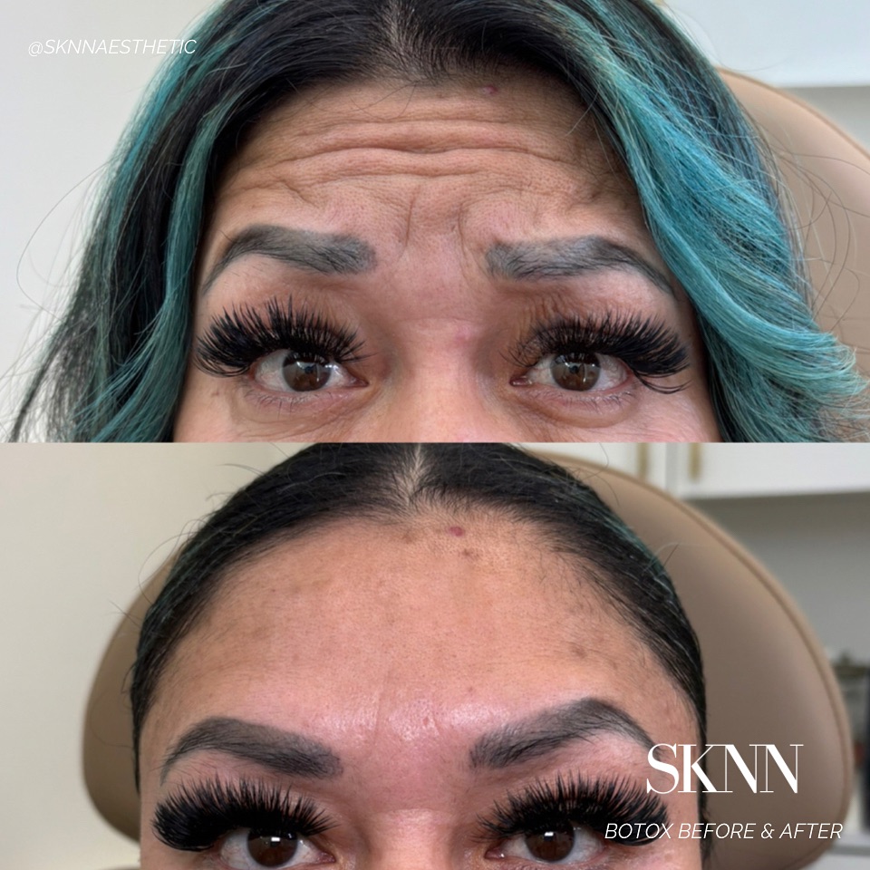 Ready to make those wrinkles disappear? Be wrinkle free this summer with Botox @SKNN ✨💉
Areas treated with botox
- forehead
- 11’s
- Crows feet
REMINDER:
Join us at our SKNN IN BLOOM EVENT, May 8th from 5-8 pm at Layered cake, we will be having some amazing specials on Botox & more so you don’t want to miss out!!! Just in time for all the summer fun 🤩
#botoxtricities #nurseinjector #tricitieswa #medspa #antiaging #tricitiesmedspa #tricitiesinjector #botox #wrinklefree #aesthetics