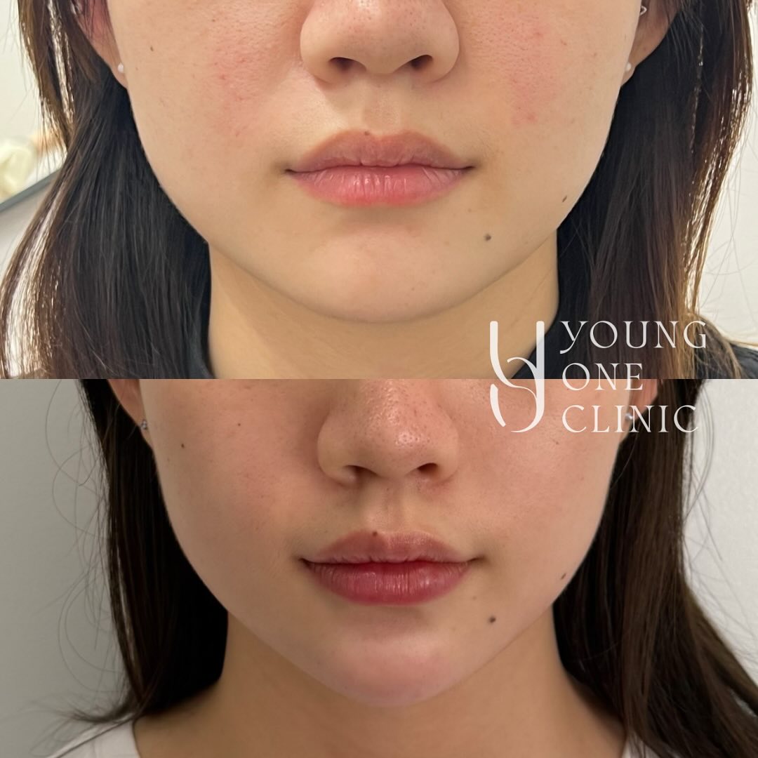 👩🏻⚕️Lower face enhancement for improved contour and proportion.
- Face slimming
- Chin
- Lips
Welcome to book in a consultation to know more about:
- Lips enhancement
- under-eye rejuvenation
- Facial balancing/ contouring
- Wrinkle reduction
- Face slimming
- Bruxism/ teeth clenching
Disclaimer: All images used with consent. Individual results vary. Always seek advice from a qualified medical professional. A thorough consult is required for suitability, risks, side effects, procedure, options and aftercare. Any cosmetic or invasive procedure carries risk.
#brisbane #lips #chin #faceslimming #jawslimming #brisbanejawlineslimming #youngoneclinic #brisbanebruxism