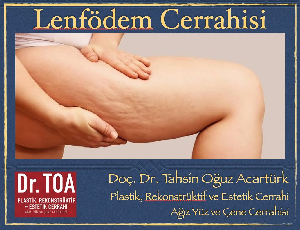1️⃣Lenfödem, özellikle ileri aşamalarında cerrahi ile tedavi edilmesi gereken bir hastalıktır.
2️⃣Cerrahi seçenekler hastaya göre düzenlenir.
3️⃣Ne kadar geç kalınırsa tedavisi o kadar zorlaşır. Erken tedavide başarı şansı artar.
4️⃣Cerrahi sonrası istenilen başarılı sonuçlar için fizyoterapi de devam etmelidir.
#lenfödem #lipödem #liposuction #mikrocerrahi #Lymphedema #lva #Bypass #lymphnode
#estetikcerrahi #marmaris #muğla #plastikcerrahi #microsurgery #ankara #istanbul #izmir #bodrum #elephantiasis#filhastalığı #upmc #pittsburgh #fiziktedavi
#lenfdrenaj #lymphovenousbypass #liposuction #lymphnodetransfer