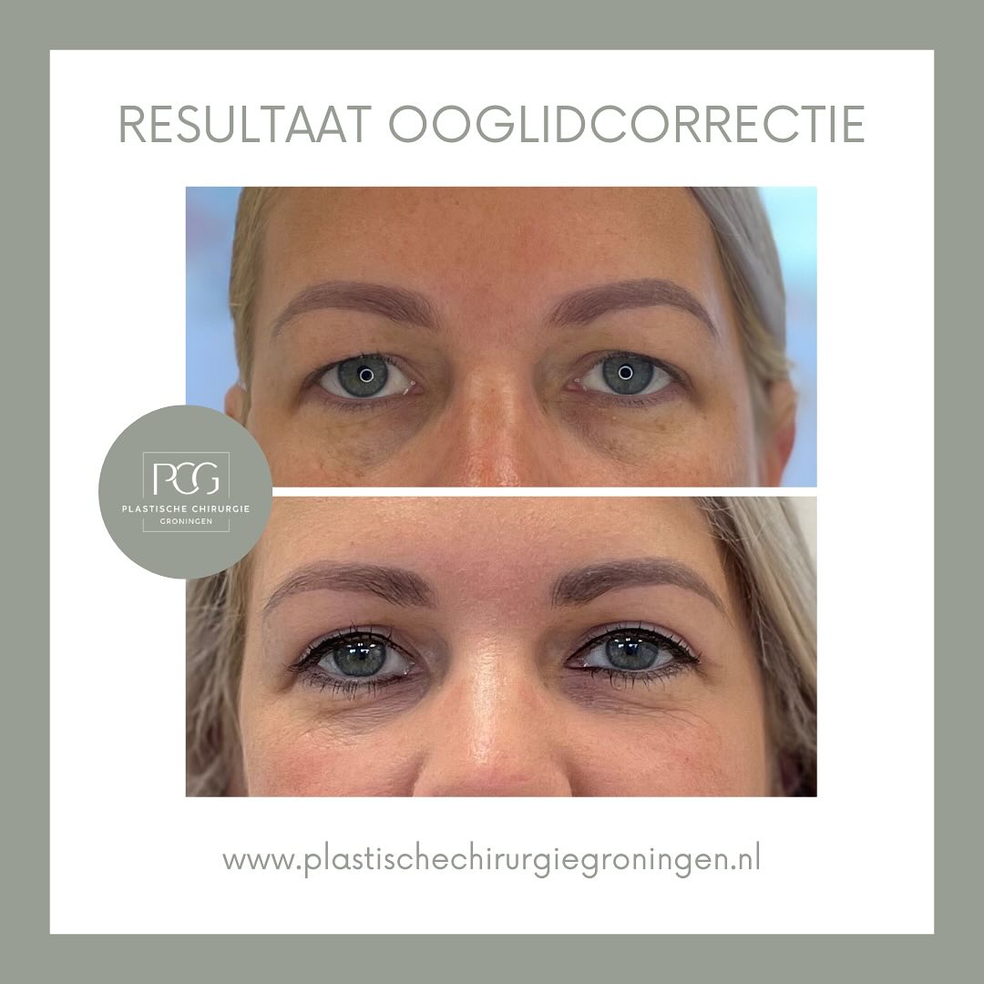 Een prachtig resultaat van een bovenooglidcorrectie en een ontzettend tevreden patiënt! 🤍✨
Foto 1: Voor de operatie.
Foto 2: Zes weken na de operatie.
Overweegt u ook een ooglidcorrectie of wilt u graag meer informatie? Neem dan gerust contact met ons op!
📞: 050 - 211 04 96
💌: info@pcgroningen.nl