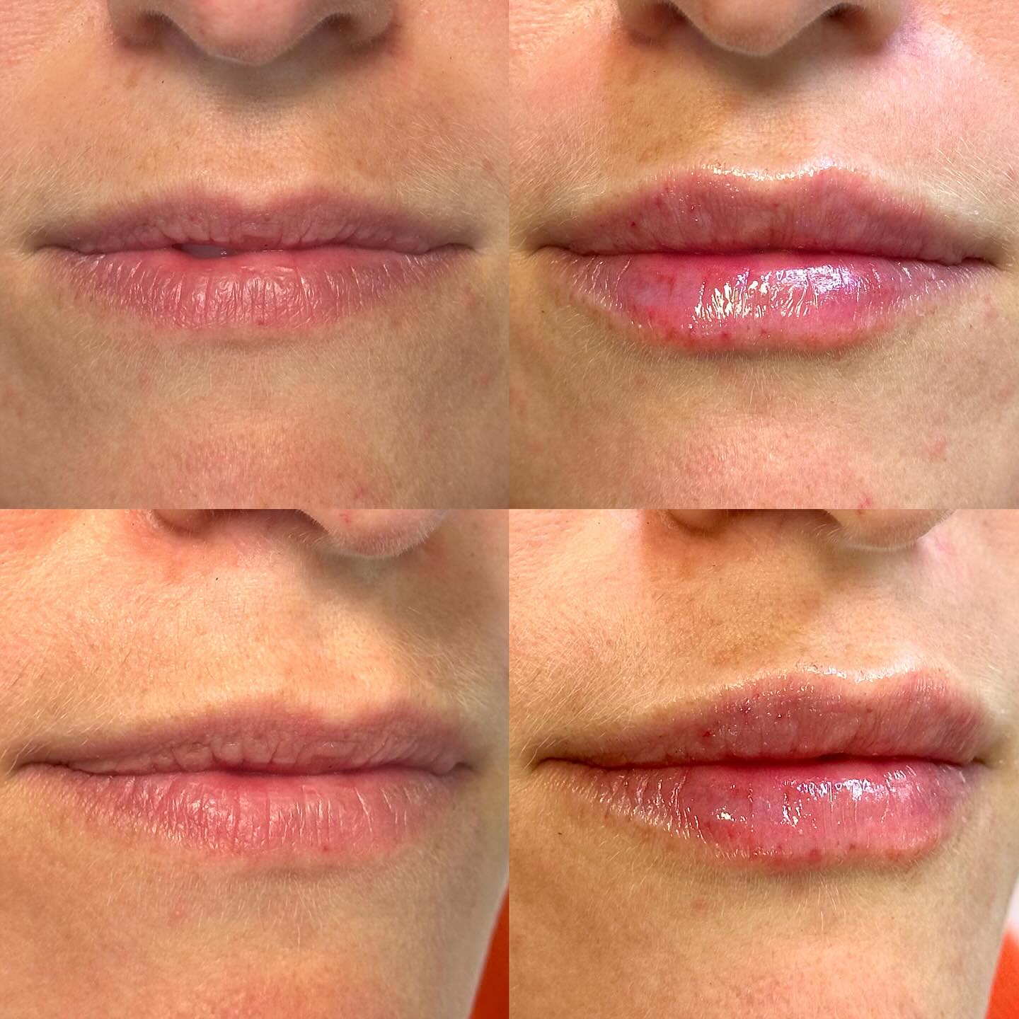 Another lip augmentation with a focus on making the lips more symmetrical and feminine using the Julie Horne technique and Restylane Kysse ❤️
#lipfillerlondon #facesymmetry #naturallipfiller #aestheticslondon