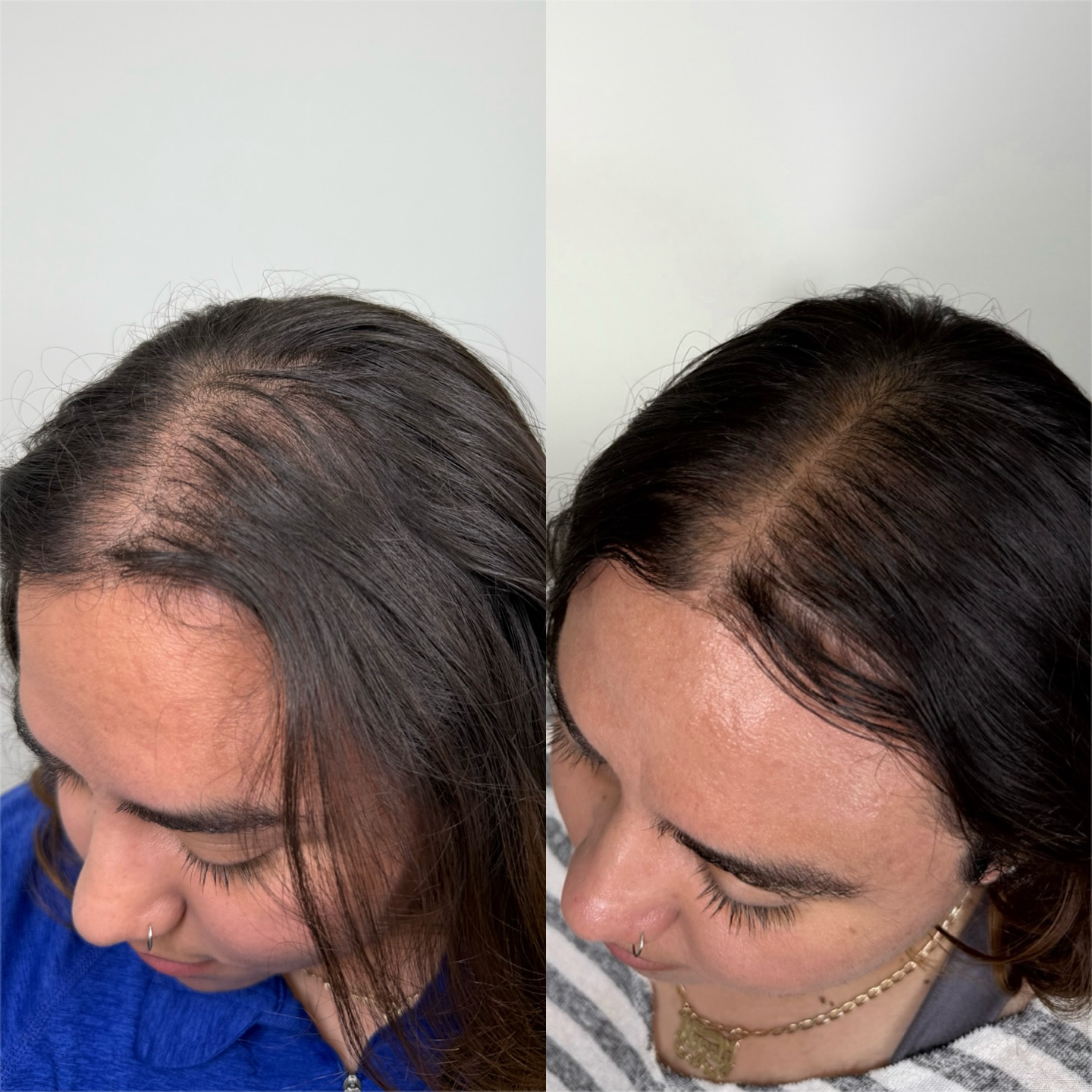 Hair Restoration in Progress ⏳— Session 2
This transformation is already speaking for itself after two treatments — thicker strands, improved density, and visible regrowth. This is the power of PRP (Platelet-Rich Plasma) therapy: using your body’s own growth factors to awaken dormant follicles and naturally boost hair health and stimulate growth.
We’re just getting started. These results are from just the early stages, and with the third session ahead, there’s even more to come! ✨
PRP isn’t just about hair — it’s about restoring confidence, one follicle at a time. ❤️
#prphairrestoration #hairrestorationwheaton #hairrestorationchicago #hairestorationnaperville #confidence #hairrestorationclinic #wheaton #naperville #chicago