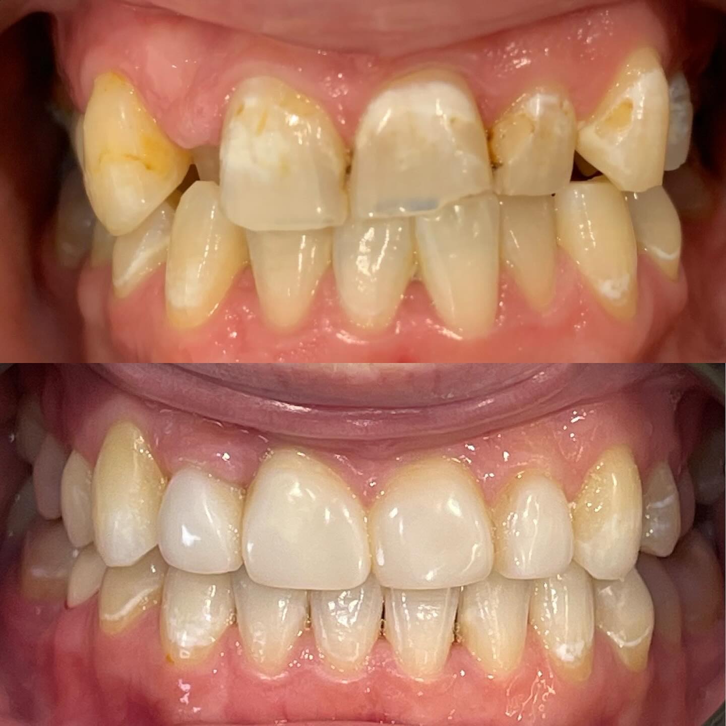 Check out this stunning smile transformation!
From alignment to brightness, we’ve covered it all:
• Comprehensive Invisalign treatment
• Anterior composite veneers for perfect contours
• Professional teeth whitening for a radiant finish
#SmileTransformation #InvisalignBeforeAndAfter #CompositeVeneers #TeethWhitening #CosmeticDentistry #SmileMakeover #InvisalignJourney #VeneersBeforeAfter #DentalAesthetics #PerfectSmile #OralHealth #DentalCare #DentistLife
*** The dental images displayed by Barwon Heads Dental are for general information and patient education purposes only. They are not a substitute for professional dental advice, diagnosis, or treatment. Individual results will vary, and outcomes cannot be guaranteed based on images alone.