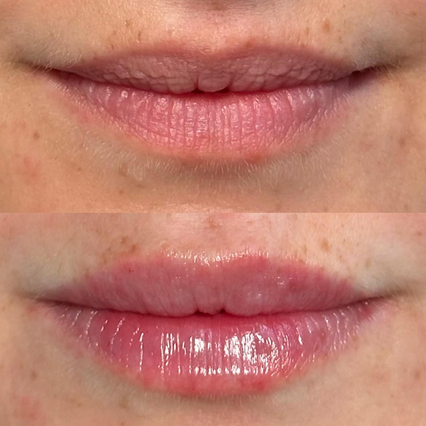 Natural lip filler undetectable at every angle ♥️💋
#naturallipfiller #lipfillerlondon #aestheticslondon #lipaugmentation