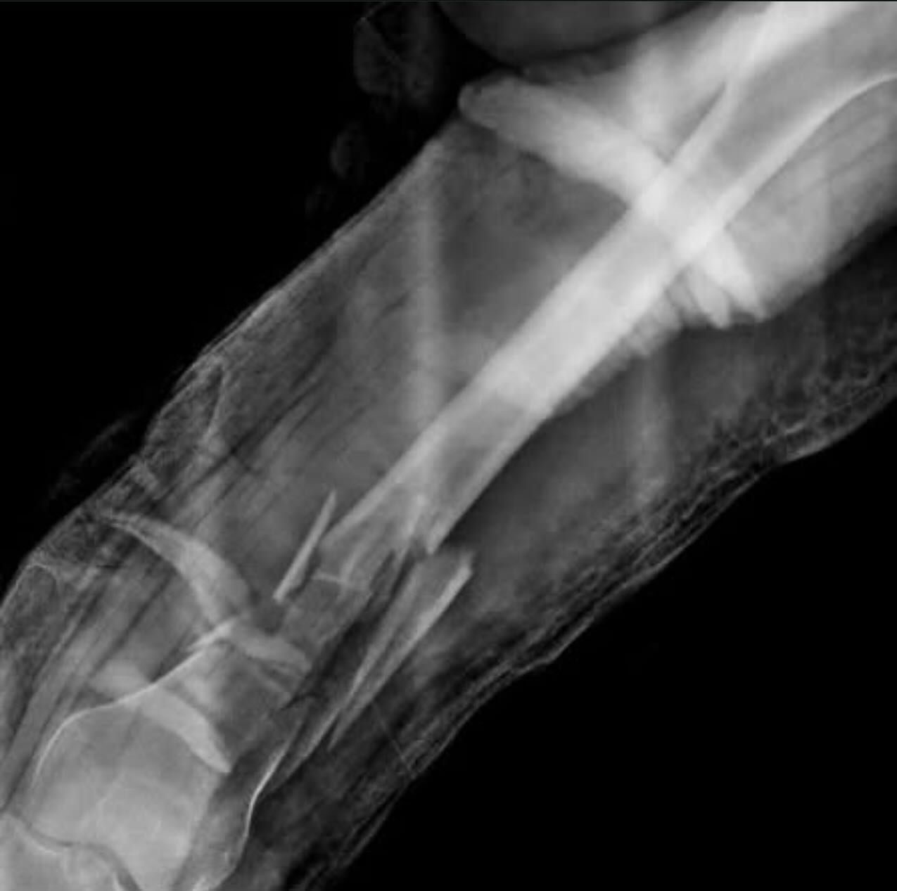 El fémur es el hueso más largo del cuerpo que puede verse afectado en accidentes de tráfico, caídas de gran altura o en situaciones donde el paciente tenga mala calidad ósea, el tratamiento muchas veces requiere de una cirugía que nos ayude a restaurar la alineación.