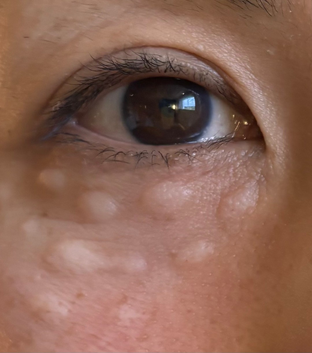 Brighten, Hydrate & Rejuvenate Your Eyes with NCTF + Nanosoft Technology
Say goodbye to tired, dull under-eyes! Our NCTF Eye Treatment uses an ultra-fine nanosoft tip for a precise, comfortable, and biocompatible application—perfect for the delicate under-eye area.
This advanced mesotherapy technique delivers potent hyaluronic acid, vitamins, and antioxidants directly into the skin to:
• Reduce dark circles
• Smooth fine lines
• Improve hydration
• Boost collagen naturally
Minimal downtime means you’re back to your routine in no time (you might just want to rock your favorite oversized sunnies for a day!)
Book now and experience the science of brighter, younger-looking eyes—without the needles.
#NCTF #NanosoftTip #EyeRejuvenation #UnderEyeTreatment #SkinBoosters #Mesotherapy #NCTF135ha #BrightEyes #MinimalDowntime #SkinClinic #GlowUp #AestheticClinic #AntiAging #BiocompatibleSkincare #ComfortableTreatment