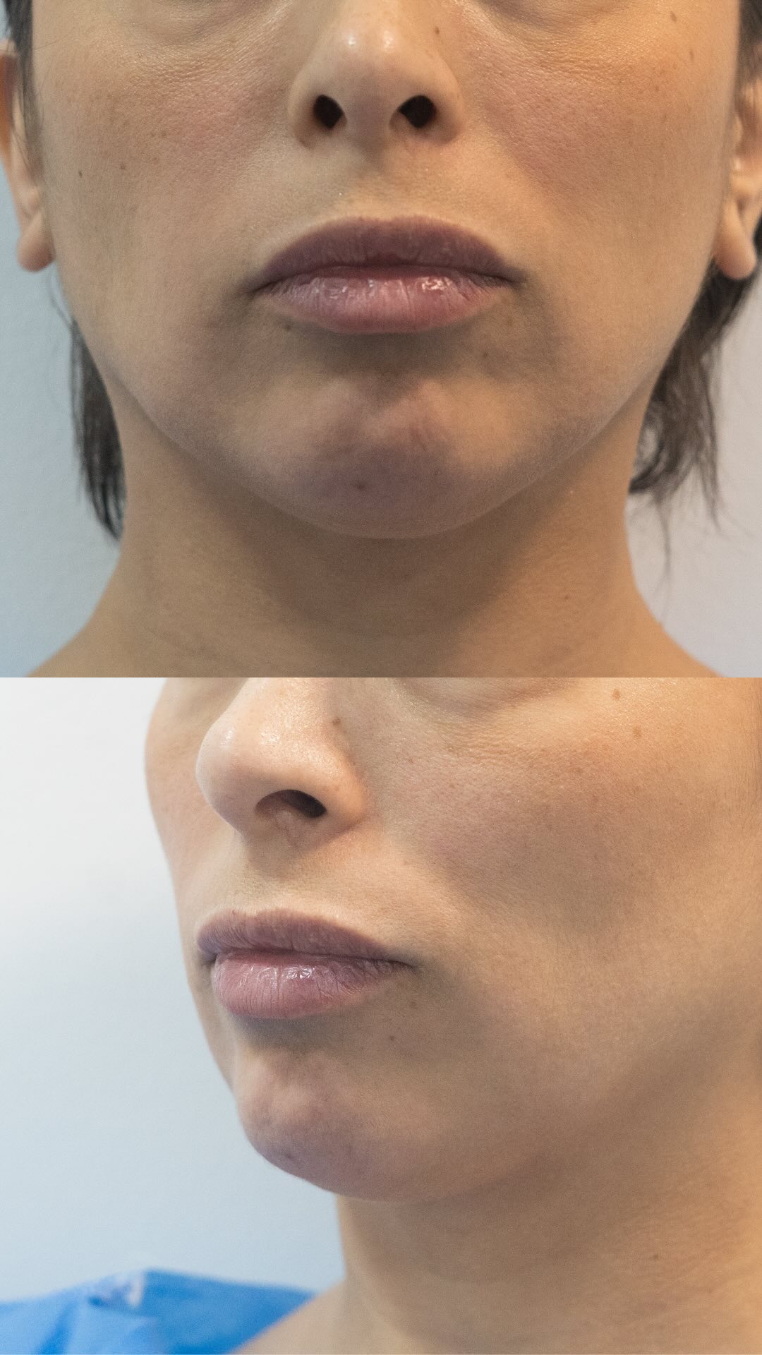 Otro resultado exitoso 🩵 rejuvenece tu sonrisa y rostro con un Upper lip lift
Encuentra todos nuestros procedimientos y promociones disponibles en www.rrtienda.com