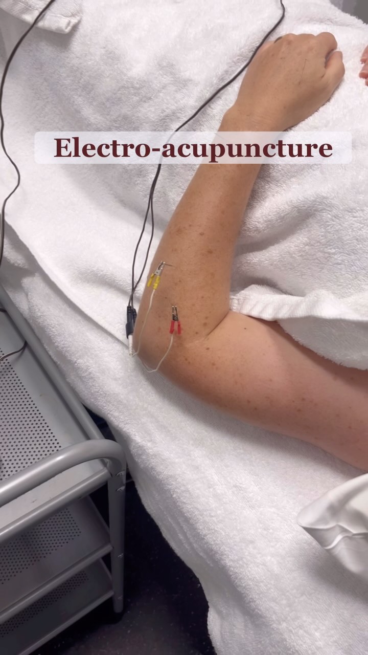 ⚡️By sending gentle electrical pulses through acupuncture needles, electroacupuncture enhances circulation, reduces pain and inflammation, and improves nerve and muscle function.
It’s like giving your acupuncture points an extra power source—amplifying the effects of traditional acupuncture for deeper, longer-lasting results.
✨ Clears stagnation
✨ Invigorates circulation
✨ Stimulates your body’s natural healing
Not just for pain—electroacupuncture can also support:
✔ Constipation & IBS
✔ Hormonal imbalances (PMS, PCOS)
✔ Immune system support
✔️ Inflammatory skin conditions
✔ Nervous system regulation
Curious if it’s right for you? DM me to chat 💬
#electroacupuncture #acupuncturebenefits #guthealth #hormonebalance #naturalhealing #acupuncturemelbourne #painreliefnaturally #tcmhealing #immunehealth #acupunctureforibs #holistichealth #modernacupuncture