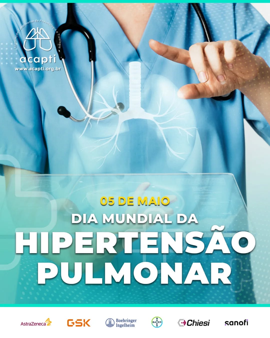 5 de Maio – Dia Mundial da Hipertensão Pulmonar
A hipertensão pulmonar (HP) é uma condição hemodinâmica grave, caracterizada pelo aumento anormal da pressão arterial nas artérias pulmonares, podendo evoluir para disfunção ventricular direita e insuficiência cardíaca.
⠀
Classificada em cinco grupos clínicos pela OMS, a HP possui múltiplas etiologias, o que exige abordagem diagnóstica criteriosa e tratamento multidisciplinar. O diagnóstico precoce, com exames como ecocardiograma, cateterismo cardíaco direito e testes de função pulmonar, é fundamental para otimizar o prognóstico.
⠀
Neste 5 de maio, reforçamos a importância da educação continuada, do reconhecimento dos sinais clínicos iniciais (dispneia progressiva, fadiga, síncope) e da ampliação do acesso aos tratamentos específicos, como as terapias vasodilatadoras e de suporte.
⠀
Profissionais bem informados salvam vidas.