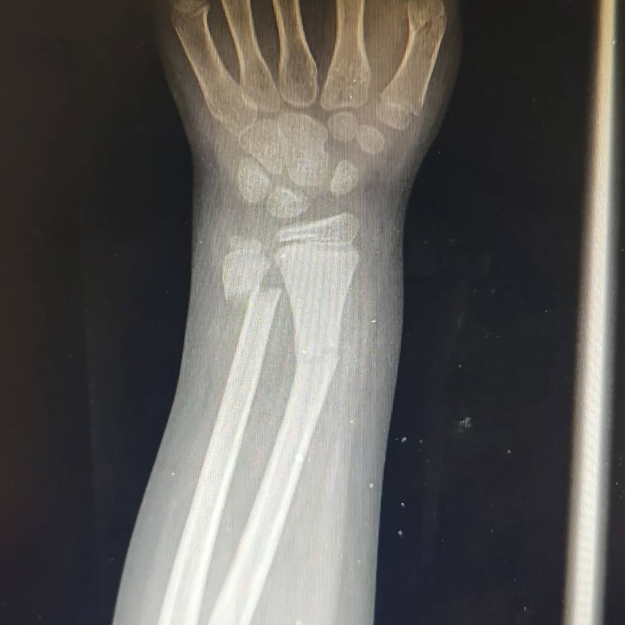 Las fracturas de muñeca son comunes en la edad pediátrica, en ocasiones un tratamiento conservador con maniobras de reducción guiadas por fluoroscopio y la colocación de un aparato de yeso pueden ayudar a restaurar la alineación y la función.