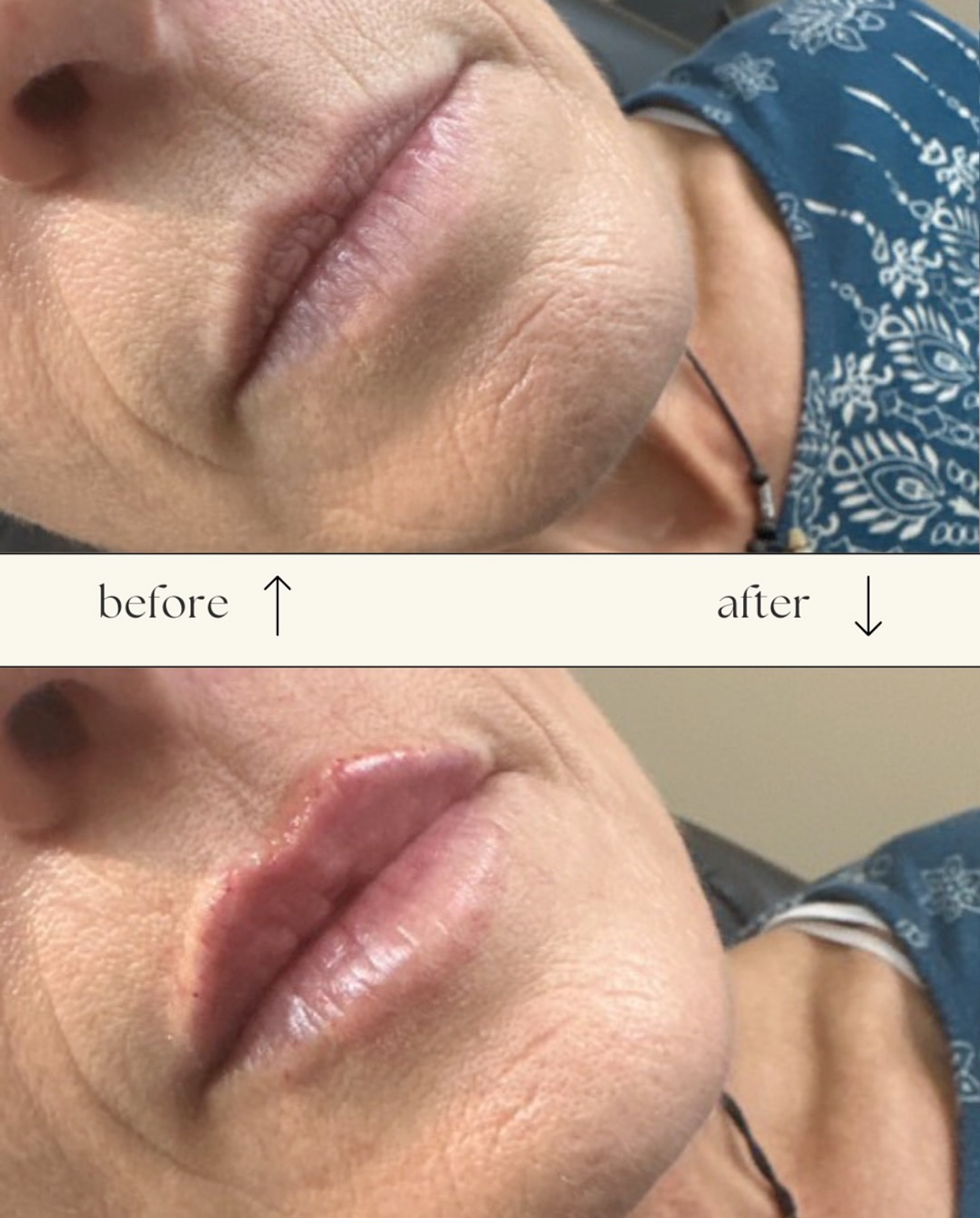 Gorgeous customized lip plump! 💉
We’re OBSESSED with this before and after!
@nurseinjector.lacey nailed this pout with just ½ a syringe KISS!
Treatment: Lip Filler - All appointments include a full consultation to discuss what you would like to achieve from your treatment, as well as talk you through the procedure. It’s also a great opportunity to get answers to any other questions or concerns you may have. Book now at www.winkswhims.com
.
.
.
.
#yyc #calgary #edmonton #okotoks #vancouver #yycmicroblading #yyceyebrows #youtube #microblading #eyebrows #brows #eyebrowgame #yyclove #calgarymicroblading #calgaryeyebrowtattoo #browtattoo #eyebrowtattoo #makeuptutorial #celebritybrows #eyebrowsonpoint #yycbeauty #yycfashion #yycfitness #yycstyle #sephora #archaddicts #browsworldwide #hudabeauty #anastasiabeverlyhills #makeuptutorial