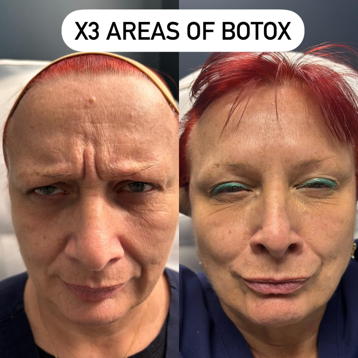 As easy as 1, 2, 3!
Just three simple areas of Botox can make a world of difference — smoothing, refreshing, and subtly uplifting your look.
Swipe to see the WOW results from our lovely Anna’s first time! She wanted to open her beautiful blue eyes. We softened her frown lines and forehead wrinkles for a natural, rejuvenated appearance she loves and treated the crows feet area to open the eyes.
Ready for your refresh? Let’s talk Botox — the results speak for themselves.
#BotoxBeforeAndAfter #WrinkleRelaxer #ForeheadBotox #FrownLines #BotoxResults #FreshFaced #FirstTimeBotox #NaturalResults #AestheticClinic #SmoothSkinGoals