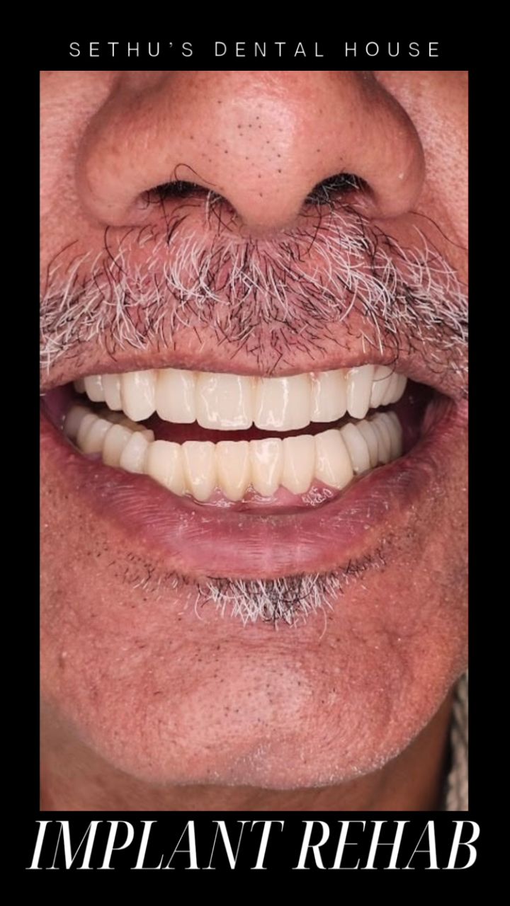Full mouth implant supported rehabilitation of a 72 years old gentleman who is still young at heart.
Precise, Pleasant and Aesthetic Dentistry By
Dr. Sethuraman Ramadoss MDS
Prosthodontist and Implantologist
Sethu's Dental House
#dentistry #dentalimplants #straumann #fullmouthrehabilitation #chennai #chrompet #Zirconia #malo