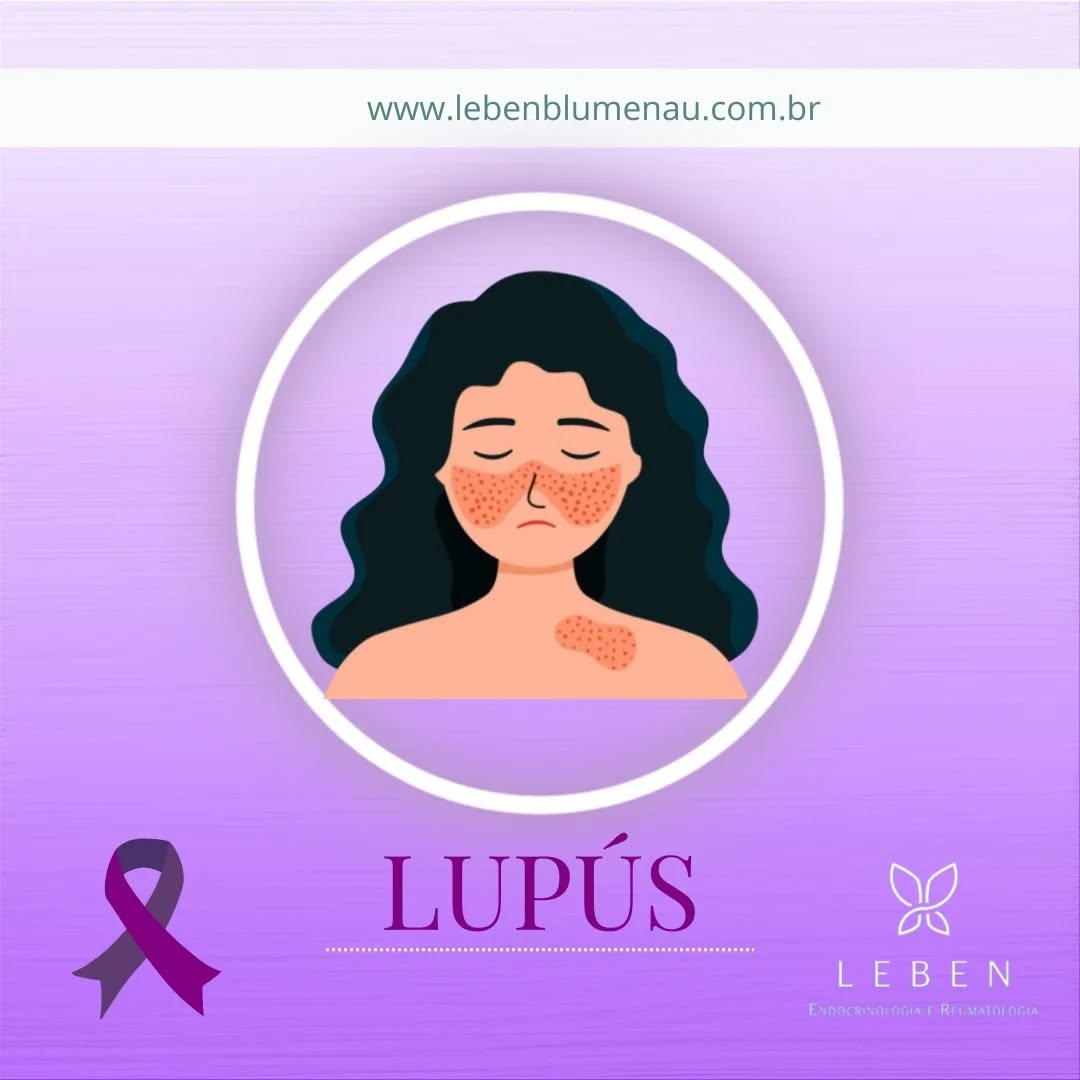 🌸✨ Maio Roxo: Mês de Conscientização sobre o Lúpus ✨🌸
Você sabia que o Lúpus é uma doença autoimune que afeta milhares de pessoas no Brasil e no mundo? Durante todo o mês de maio, usamos a cor roxa para chamar atenção para essa condição que muitas vezes é difícil de identificar e compreender.
O Lúpus pode causar sintomas variados, como fadiga, dores nas articulações, febre, manchas na pele e até complicações mais sérias. Por isso, é fundamental estar atento aos sinais e procurar um médico se algo parecer diferente.
Vamos juntos aumentar a conscientização, combater o preconceito e apoiar quem vive com essa doença! Compartilhe essa mensagem e ajude a espalhar informação e empatia. 💜
#maioroxo #conscientizaçãolúpus #saude #autoimune #lupus #prevenção #empatia