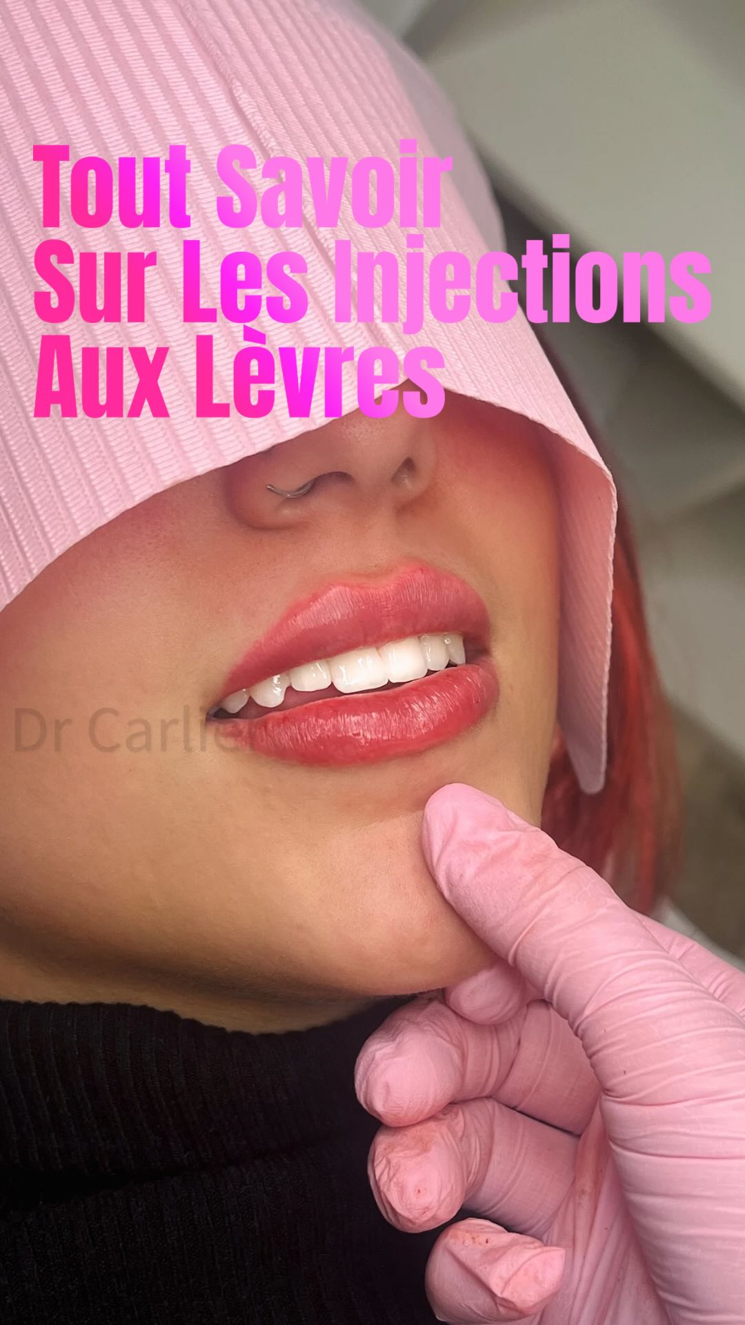 Et si on discutait un peu des injections au lèvres ?
Je réponds à toutes vos questions concernant les injections au lèvres
#lipsfiller #injectionslevres #medecineesthetique #beautytips #selfcare #glowup