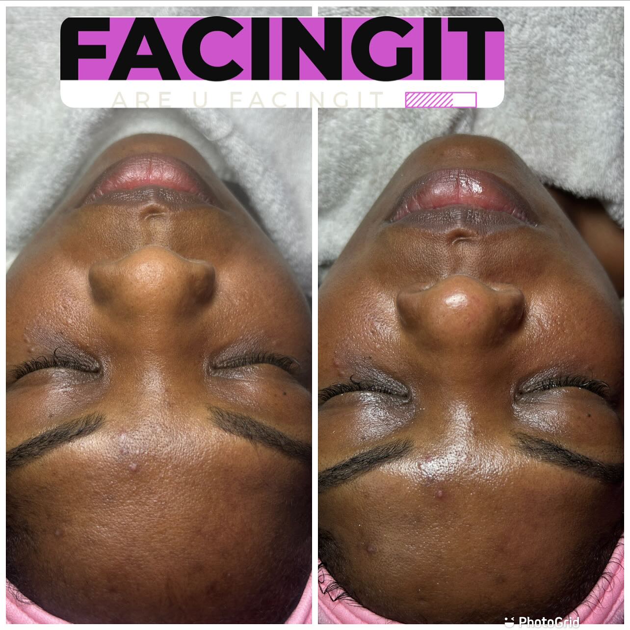 Dermaplaning is a skin treatment that uses an exfoliating blade to skim dead skin cells and hair from your face.Dermaplaning aims to make your skin’s surface smooth, youthful, and radiant. This treatment can aim to remove deep scarring from acne and uneven skin tone on your skin. It’s also used to remove “peach fuzz,” the short, soft hairs on your face.
Benefits Of Facials
* Reduce Stress And Relieve Psychological Distress.
* Cleanse Your Skin.
* Prevent Aging. ...
* Facial Massage Promotes Blood Circulation. ...
* Rejuvenate Your Skin. ...
* Facials Help Detoxify The Skin. ...
* Treat Acne And Acne Marks. ...
* Eliminate Whiteheads And Blackheads.
Follow my business page @_FacingIt & check out some of my work
Website: AubriaFacingIT.com
Are You FacingIT
#Atlanta #AtlantaLife #AtlantaFood #AtlantaEats #AtlantaNights #AtlantaStyle #AtlantaArt #AtlantaPhotos #AtlantaPhotography #AtlantaStreets #AtlantaTimes #AtlantaLiving #AtlantaLifestyle #AtlantaMoments #AtlantaLove #PeopleOfAtlanta #AtlantaFashion #AtlantaMusic #AtlantaNightlife #AtlantaDaily #AtlantaFitness #AtlantaFit #AtlantaInfluencer
#AtlantaBlog #AtlantaShopping #AtlantaRestaurants #AtlantaFoodie #AtlantaAdventures #AtlantaVibes #AtlantaHomes