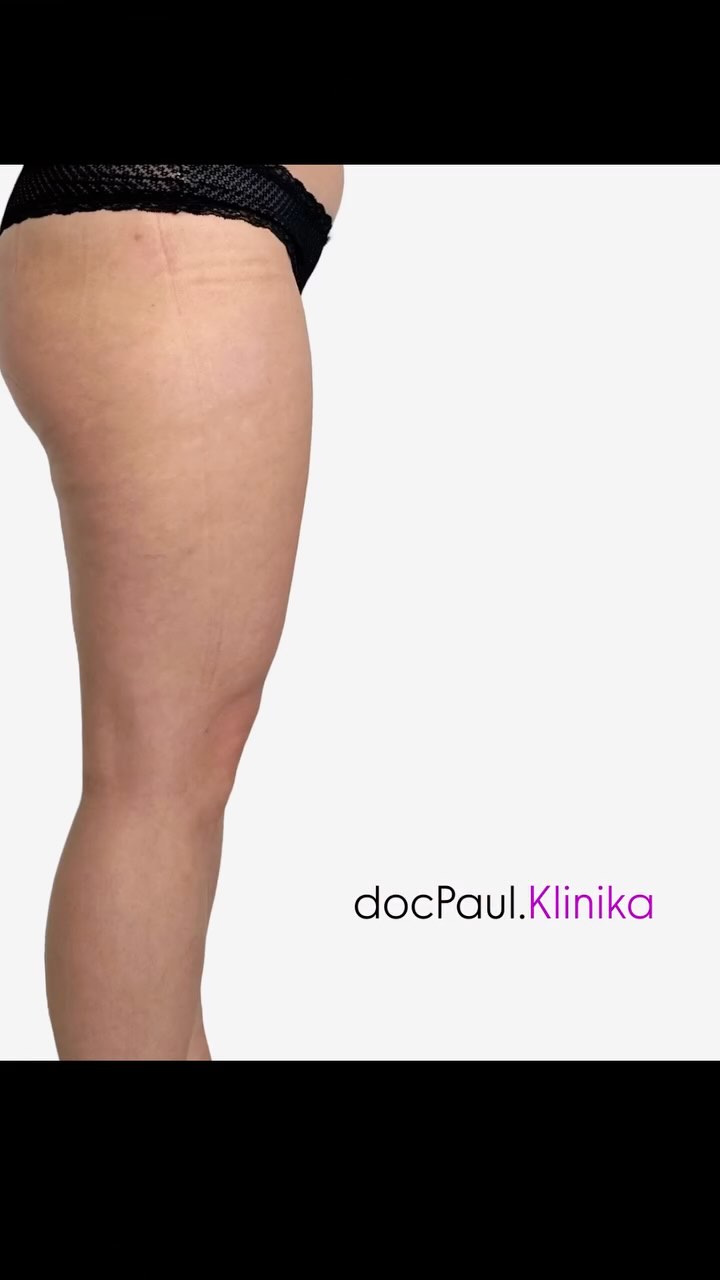 Przedstawiamy Państwu naszą przesympatyczną💐 pacjentkę po 3 miesiącach od zabiegu modelowania ud przy pomocy zabiegu liposukcji.
Dzięki szczegółowemu planowaniu oraz algorytmowi postępowania pooperacyjnego + fizjoterapii, mogliśmy uzyskać naturalny, harmonijny wygląd.🙌🏻
Operował:
dr n. med. Maciej Stala
@dr_stala
#docpaul #bytom #plasticsurgery #chirurgplastyk #liposuction #liposukcja