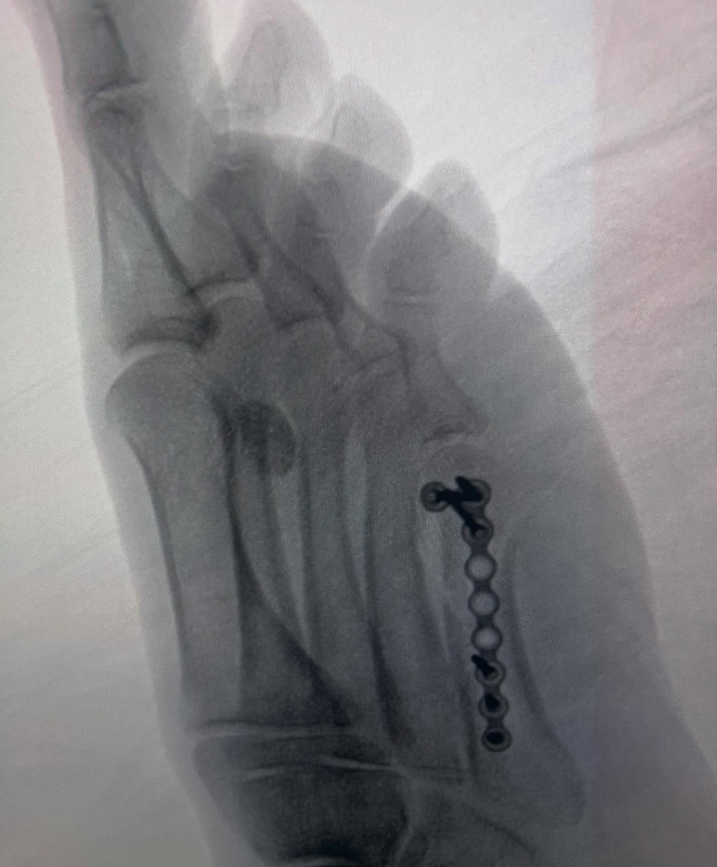 Las fracturas de metatarso en ocasiones requieren de un tratamiento quirúrgico para garantizar una adecuada alineación y restituir la longitud del hueso. #fractura #metatarso.