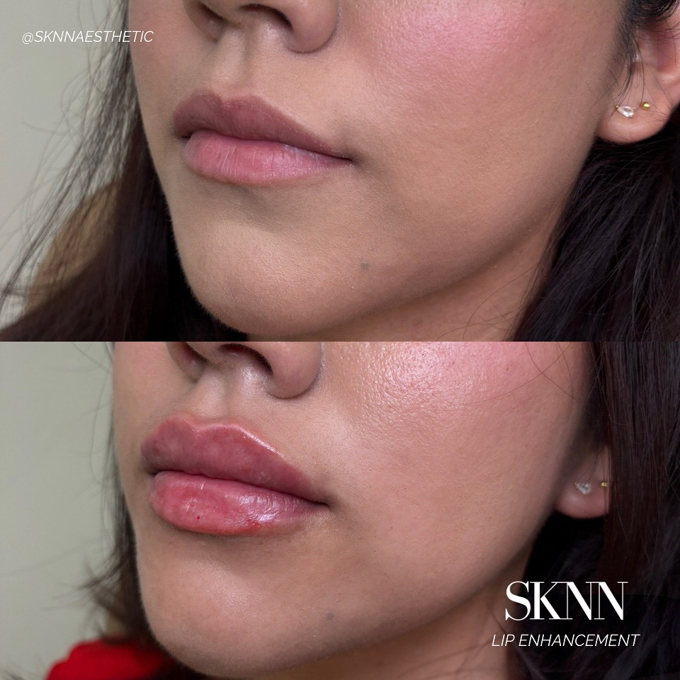 SKNN signature lips
The Goal is volume & definition always, a shape that enhances your natural features, and volume that's as subtle or plump as you desire ✨
Take advantage of our current specials on our site if you’ve been thinking about booking that appointment 😊
#lipfiller #lips #nurseinjector #tricitieswa