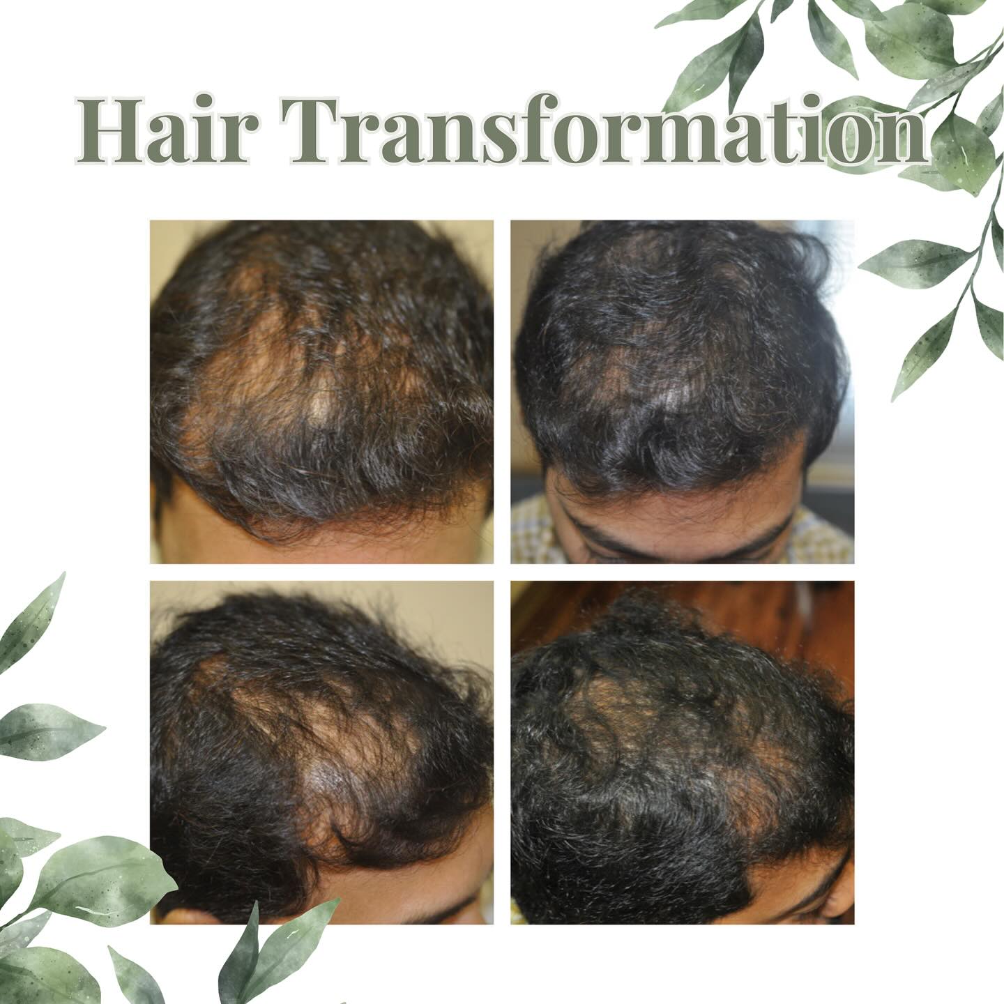 Looking for an easy, quick, and effective treatment for hair renewal? Check out these incredible hair restoration results! Contact us today to learn more about microneedling for amazing and thicker hair growth. We are dedicated to helping you look and feel like the best version of yourself✨
#microneedling #prp #hairgrowth #hairrestorarion #thickerandfullerhair #untouched #beauty #skincare #haircare