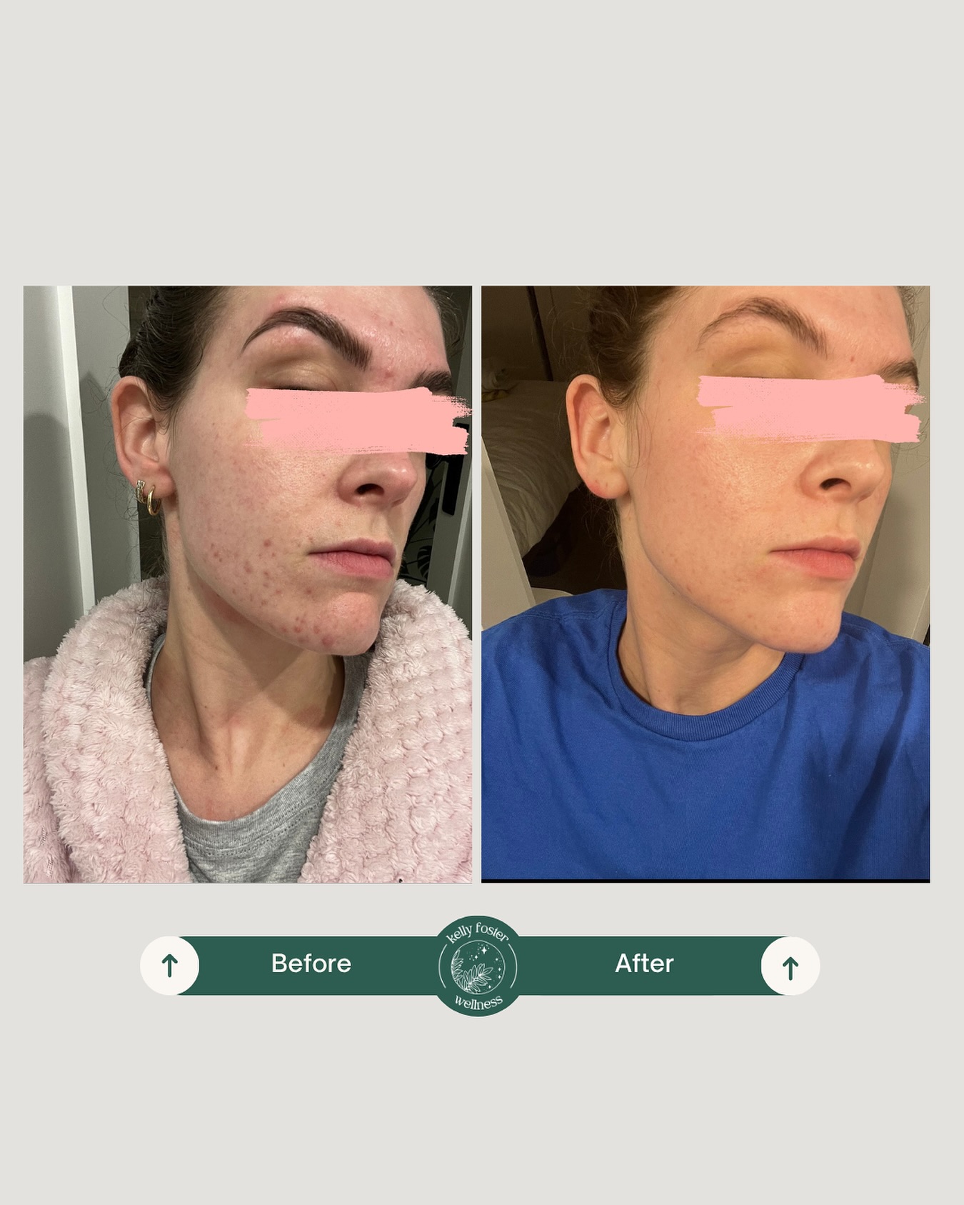 From reactive skin to long-term skin health.
This client came to me experiencing:
– Hormonal breakouts and painful periods
– High anxiety and nervous system dysregulation
– FODMAP sensitivity and reactive digestion
– A disrupted skin barrier from long-term peel use and harsh actives
We worked together intensively over 3 months, followed by ongoing supplement support and check-ins over the last 6 months. She knew exactly what she was working towards—and the consistency paid off.
👉 Focused on nervous system regulation – the body must feel safe to heal
👉 Ran functional testing: general bloods + microbiome analysis
→ Rhodotorula spp, Streptococcus spp, and low beneficial flora identified
👉 Opened detox and lymphatic pathways
👉 One-month gut clearing protocol
👉 Four weeks of recolonising and rebuilding the gut
👉 Adjusted skincare to be gentle yet targeted, repairing barrier damage
👉 Completed a round of bio-microneedling to support cell turnover and reduce scarring
The result?
✅ Calm, balanced skin with even tone and regulated oil production
✅ Pain-free, regular menstrual cycles with no breakouts
✅ Most FODMAPs successfully reintroduced, only avoiding high dairy items now
✅ Stable, healthy digestion
This is the power of targeted, root-cause healing.
Book your Initial Acne Consult today and see where your skin could be in 3 months.
#acnetreatment #hormonalacne #guthealth #skinhealing #naturalacnetreatment #naturopathicmedicine #acnejourney #holisticskincare #skintransformation #digestivehealth #functionalmedicine #naturopath #acnesolutions #skinbarrierrepair #acnebeforeandafter