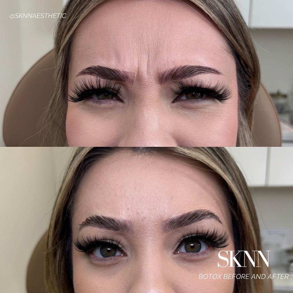 Tired of seeing those fine lines and wrinkles? Botox can help relax those muscles, book your appointment now @sknnaesthetic
Areas treated
- forehead
- 11’s
REMINDER: We currently have our spring specials live in our bio. Sales will end tomorrow! Take advantage of some good deals and prepare for the summer festivities ✨
#botoxtricities #nurseinjector #tricitieswa #medspa #antiaging #tricitiesmedspa #tricitiesinjector #botox #wrinklefree #aesthetics