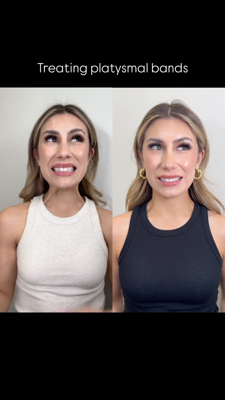 Treating platysmal bands with Botox — an FDA-approved method for improving the appearance of the neck. By relaxing the vertical neck muscles, we can achieve a smoother, more defined jawline and youthful neck contour.
Results are powerful, with minimal downtime.
Would you try this? We currently have amazing promotions going on for all treatments link in bio ✨💉
#neckbotox #platysmalbands #Injectables #tricitiesnurseinjector #medicalspa #botoxtricities #botoxinjections #antiaging