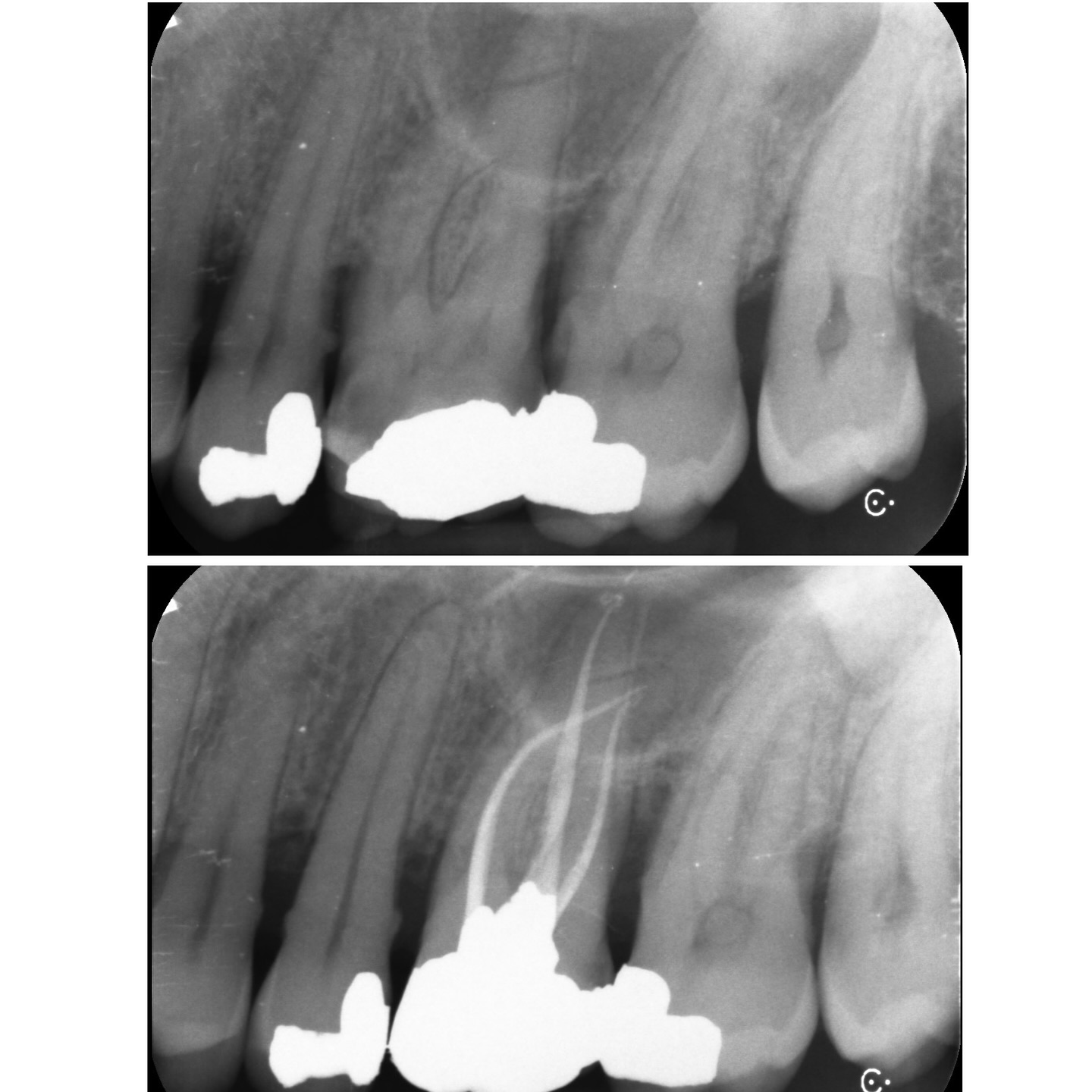 UL6 SIP/SAP. Long curved roots esp MB. 4 canals 3 exits. WVC. 28mm mb root required careful prep and small shapes kept in the buccal canals #dentistrylife #dentistrylove #dentallife #oralhealth #veneers #dentalhygiene #healthysmile #dentalhealth #dentures #dentallab #dentalschool #dentalassistant #endodontics #smilemakeover #dentistica #dentist #cosmeticdentist #dentistlife #ortheodontics #dental #funnydentist #dentistry #dentistlife #dentalclinic #dentalassistant #dentista #dentistica #dentistrylove #dentists #dentistry student