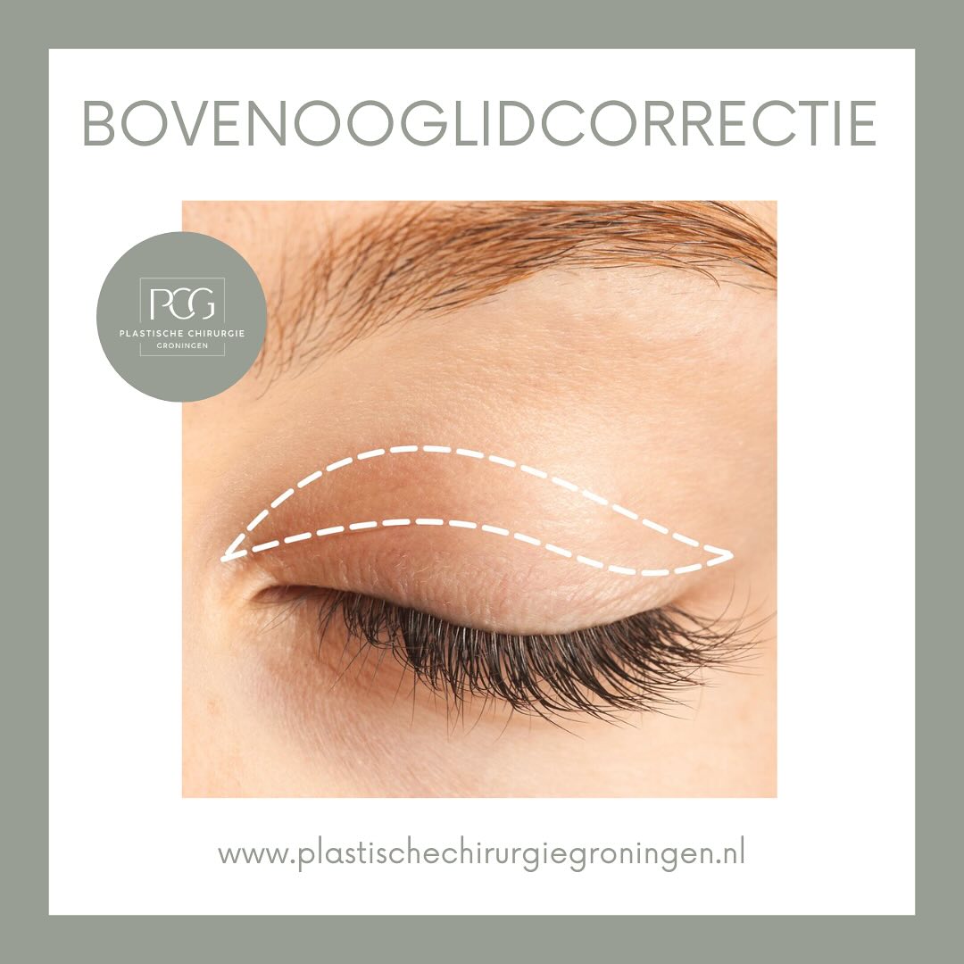 Het komt vaak voor dat de huid en spieren rond de ogen verslappen. Dit hoeft niet altijd het gevolg te zijn van het ouder worden. Uw gezichtsuitdrukking komt dan niet overeen met hoe u zich voelt. Door middel van een (boven)ooglidcorrectie lossen onze ervaren plastisch chirurgen dit voor u op!
Wilt u meer informatie betreft de mogelijkheden voor een ooglidcorrectie? Neem dan snel contact met ons op!
📞: 050 - 211 04 96
💌: info@pcgroningen.nl