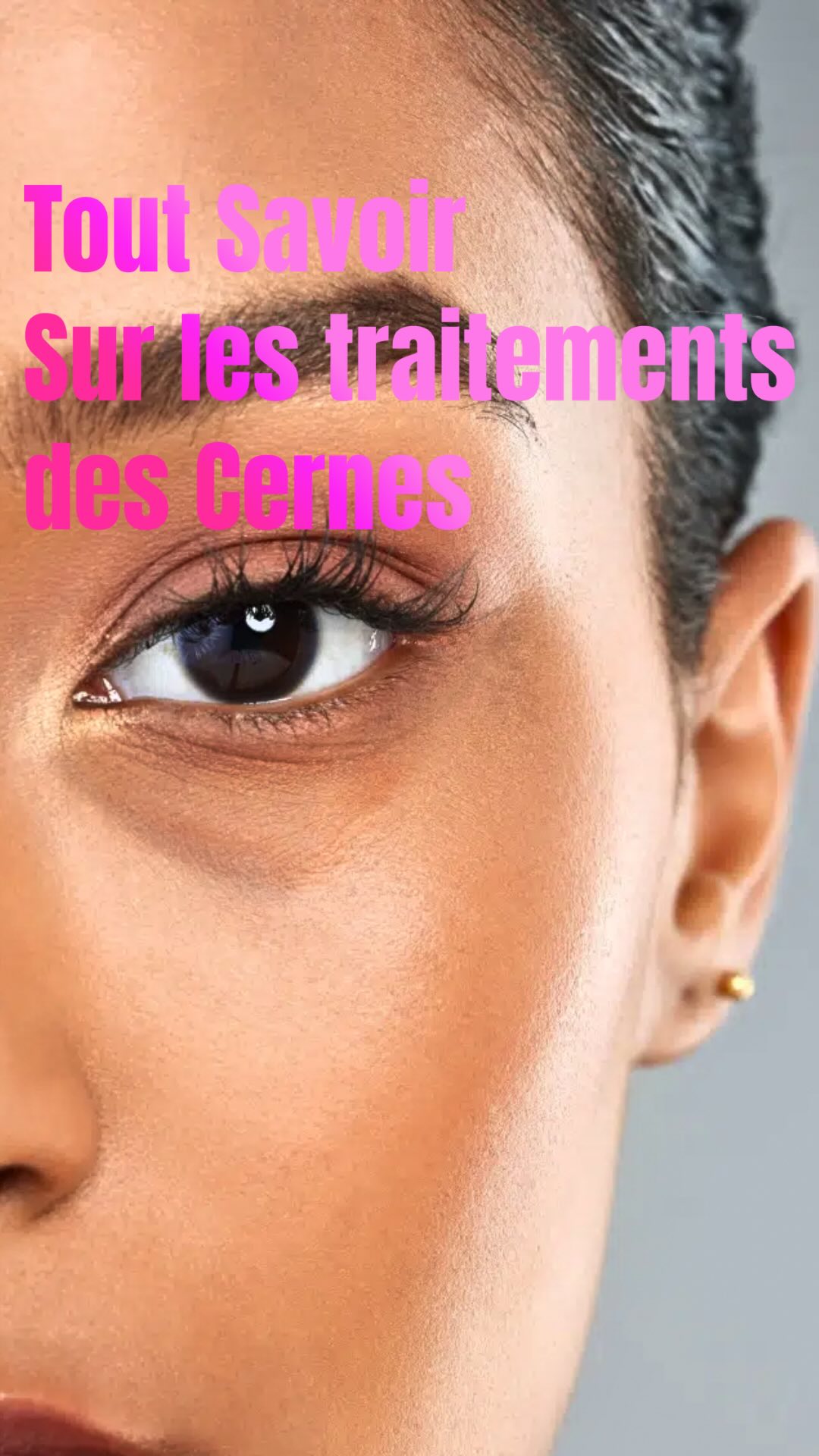 Et si on parlait un peu des traitements pour les cernes?
Je réponds à vos questions pour le traitement des cernes.
#medecineesthetique #injections #botox #glowupjourney