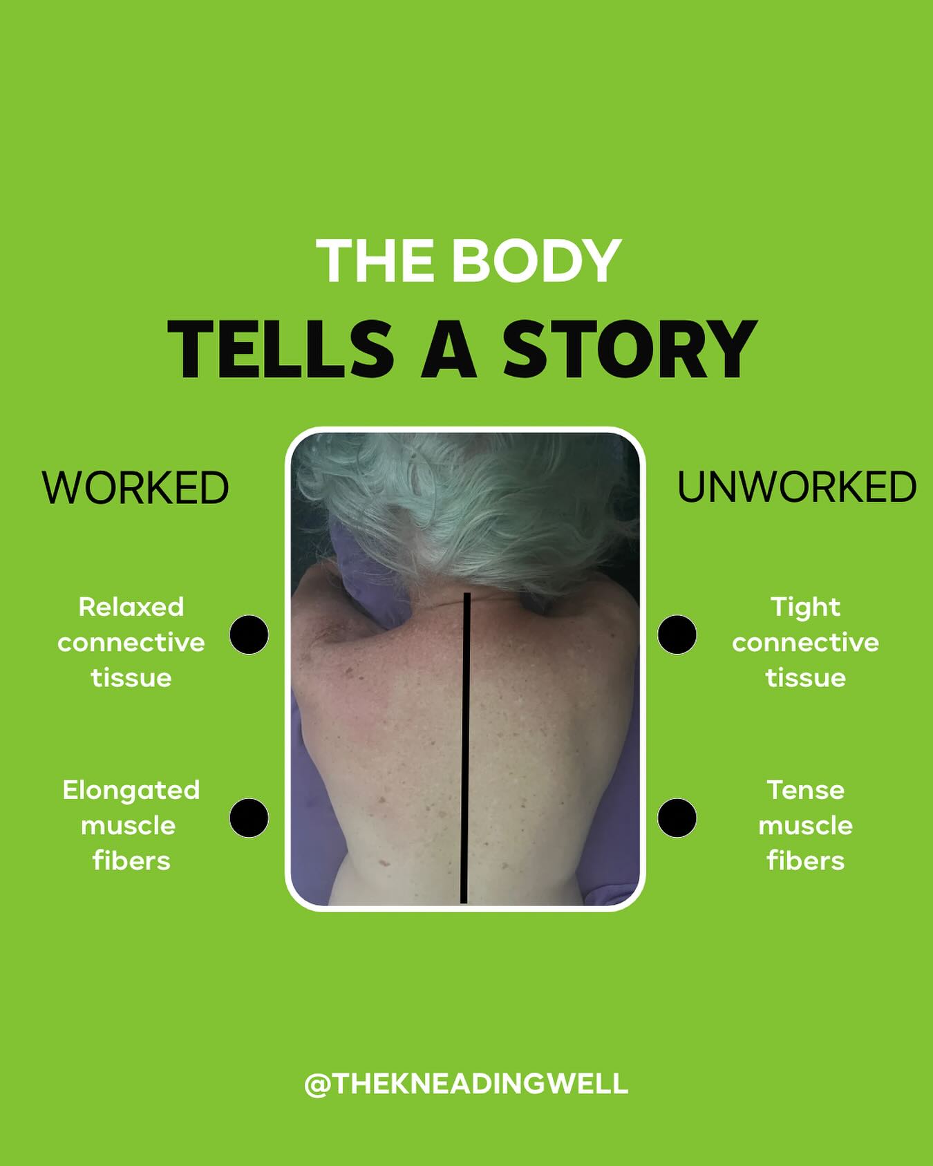 šš½ IF YOUR BODY COULD TALKā¦
::
ā¦it actually does and these hands are very good listeners šš½
One of the main characters in this story is that pesky Levator Scapulae. It lives from the top of the neck at the base of the skull and travels down to the inner top border of the scapula.
Levator scapulaeās primary job is to elevate the scapula (shoulder blade) for movements like shrugging the shoulders. You get the name now š. It also acts with other muscle movers around it to rotate the shoulder forward and downward, laterally flex the neck to the same side and extend the neck backward.
It can be one real pain in the neck and indeed for this client it was. With the right techniques, tools and topicals, levator scapulae and its muscular friends on the left side of this picture were helped to chillax a bit. You can visibly see the restored space between the base of the neck and the shoulder joint. You can see how the shoulder is relaxed away from the ears. And you see how the shoulder is less protracted and more depressed which decreases the strain and pull of the other back muscles. This all leads to better alignment in the spine.
Kyanni - 1
Neck - 0
Client - L00sey G00sey
You need us. We knead you.
::
#thekneadingwell
#massagetherapy
#catonsvillemassage
#baltimoremassage
#relaxation
#tensionrelief
#neckpainrelief
#therapeuticmassage