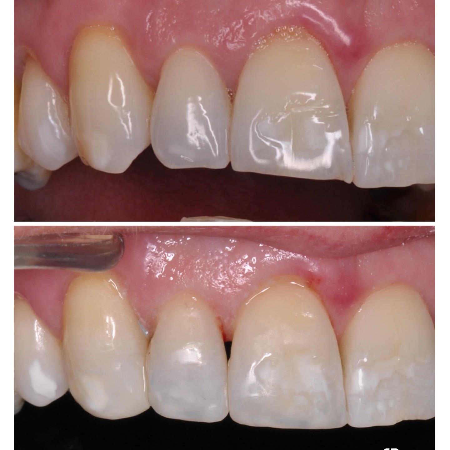 Edge bonding of UR123 to balance the smile while replicating natural stain characteristics #nhs #treat #treatment #endowarrior #endodontia #rootcanaltreatment #rootcanaltherapy #endobelly #waves #waveonegold #saveteeth #endospecialist #treatyourself #simplicity #dentaltreatment #compositebonding #dentistry #endodontics #dentaltreatment #difficultendo @jojomarie68