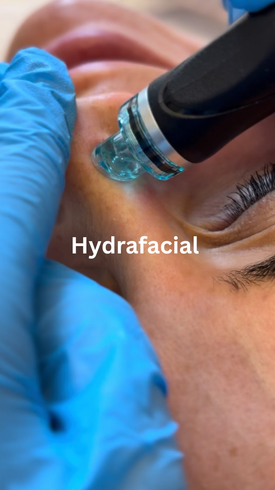 Frischer Glow gefällig? ✨💧
In diesem Reel seht ihr, wie ein Hydrafacial bei uns abläuft – Schritt für Schritt.
Sanfte Reinigung, Peeling, Feuchtigkeit und individuell abgestimmte Booster sorgen für eine sichtbar frischere, gesündere Haut. 💆♀️💙
Egal ob gestresste, fahle oder unreine Haut – wir passen die Behandlung genau auf eure Bedürfnisse an und bringen eure Haut wieder zum Strahlen.
Perfekt auch im Sommer – ganz ohne Ausfallzeit!
#hydrafacial #glowingskin #skincare #ästhetikpraxis #medicalbeauty #hautpflege #facialtreatment #sommerhaut #reinehaut #glowup #schönheitschirugie #ästhetik #facharzt #drmonarudolph #plastischechirurgie #beauty #reinehaut #ausreinigunggesicht