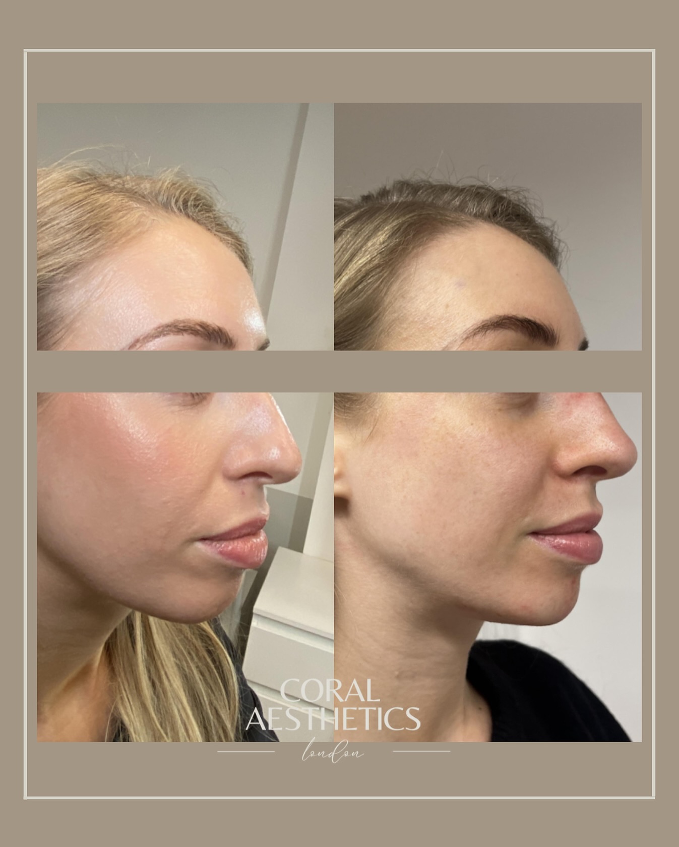 Let’s Talk About Profile Balancing 💉
You might have heard of a non-surgical nose job 👀 well... that magic is thanks to profile balancing.
Explained simply, Nurse Coral focuses on enhancing harmony within your features. Sometimes subtle tweaks can bring your natural features into even greater alignment.
How does it work? Well... we use dermal filler to enhance certain features - focusing on areas like the chin, nose, lips, and jawline to softly sculpt and refine your profile - not to dramatically change how you look, but to create flow, balance, and definition that still feels uniquely you.
No overdone look. No one-size-fits-all approach. Just a personalised plan that complements your features and boosts your confidence.
📩 DM us to book your consultation with Nurse Coral and explore what profile balancing could look like for you.