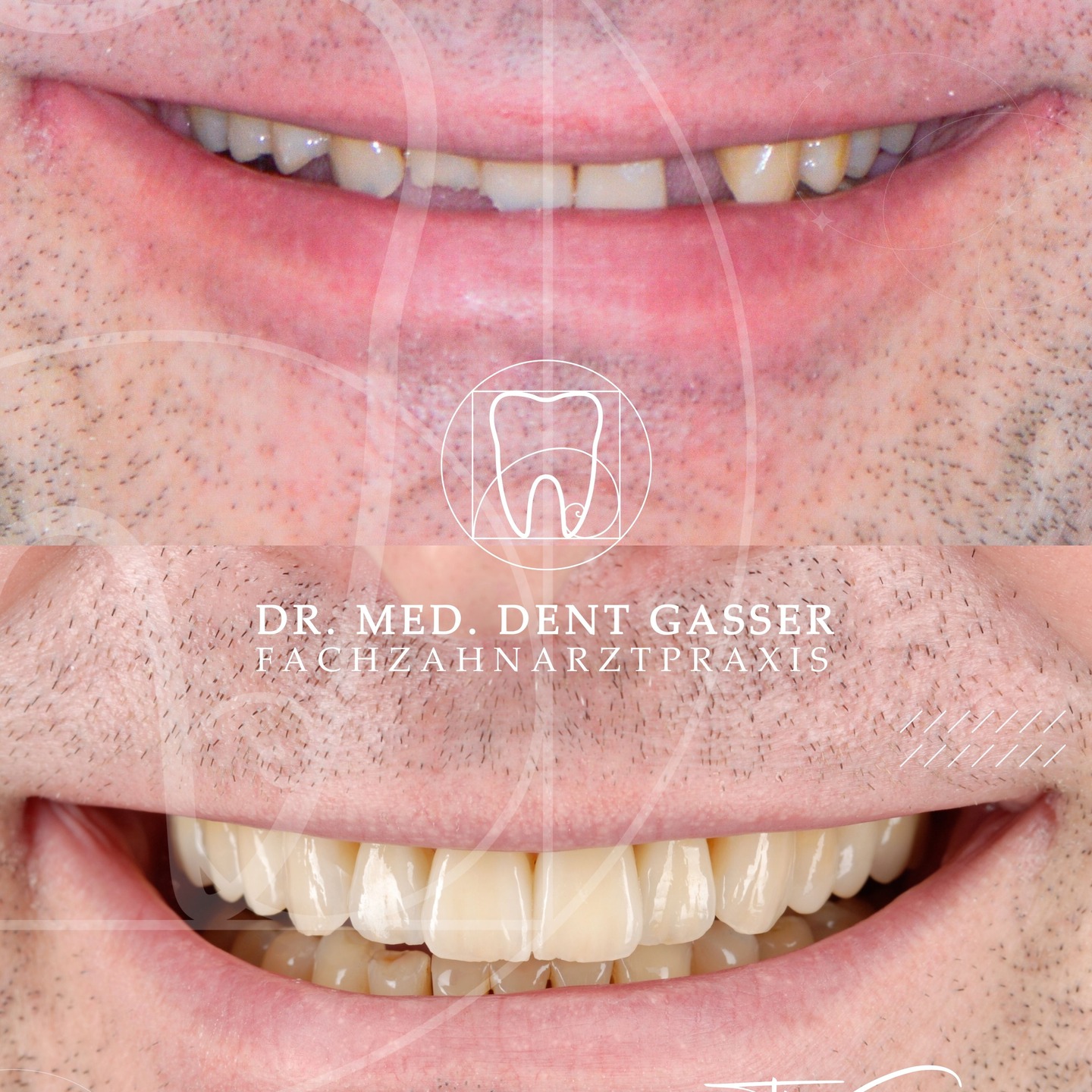 🦷 Gesamtsanierung mit Feingefühl & Präzision
Dieses Vorher-Nachher-Beispiel zeigt die ästhetische und funktionale Wiederherstellung eines stark abgenutzten Gebisses – behutsam, substanzschonend und meisterhaft umgesetzt.
✨ Minimalinvasiv statt radikal
Alle Zähne wurden mit hochwertigen Teilkronen versorgt. Es wurde kaum mehr beschliffen, als durch den natürlichen Zahnabrieb (Attrition) bereits verloren gegangen war.
So bleibt gesunde Zahnsubstanz maximal erhalten.
🦷 Implantat statt Lücke
Ein verloren gegangener Frontzahn wurde präzise durch ein Implantat von Dr. Gasser ersetzt – funktional belastbar und ästhetisch perfekt integriert.
🛠️ Teamarbeit auf höchstem Niveau
Dank zahntechnischer Meisterleistung entstand ein Ergebnis, das nicht nur natürlich aussieht, sondern auch langfristige Stabilität und Kaueffizienz garantiert.
😁 Das Ergebnis:
Ein harmonisches Lächeln, das Natürlichkeit, Funktion und Ästhetik vereint – individuell geplant und mit modernsten Methoden umgesetzt.
Behandlungsschritte im Überblick:
• Präzise digitale Planung der Gesamtsanierung
• Minimalinvasive Teilkronen auf allen Zähnen
• Frontzahnimplantat durch Dr. Gasser
• Hochästhetische Keramik
• Zahntechnische Meisterarbeit für höchste Passgenauigkeit
📍 Fachzahnarztpraxis Dr. Thomas Gasser
Greifengasse 1, 4058 Basel
📞 Telefon: +41 61 681 00 10
📧 E-Mail: fachzahnarztpraxis_basel@sso-hin.ch
🌐 Website: www.densartis.ch
#ZahnarztBasel #GesundesLächeln #BaslerZahnarzt #Basel #BaselSwitzerland #Schweiz #Baselstadt #BaselLiebe #Zahnmedizin #Zahnarztpraxis #Zahngesundheit #Implantologie #Zahnersatz #Prophylaxe #ÄsthetischeZahnmedizin #MittlereBrücke #Straumann #DrThomasGasser #ZahnarztImplantate #Lächeln #GesundeZähne #ZahnmedizinMitHerz #ZahnarztpraxisBasel