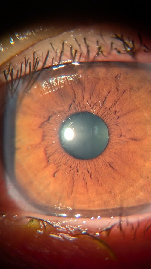 5 Things My Patients Are Doing RIGHT 🙌✨
Let’s give some love to the good habits that help keep your eyes happy and healthy 👁️💖
✅ Daily eyelid hygiene
✅ Following the 20-20-20 rule (every 20 mins, look 20 ft away for 20 sec!)
✅ Using dry eye drops regularly—not just when it’s bad!
✅ Wearing sunglasses to protect against UV all year
✅ Removing makeup gently & replacing eye products on time
Your eyes are thanking you! 👏
Keep it up, fam 💪
#eyecaretips #dryeyes #healthyhabits #winwin #uv #allyear #optometristapproved #eyetalkdoc#