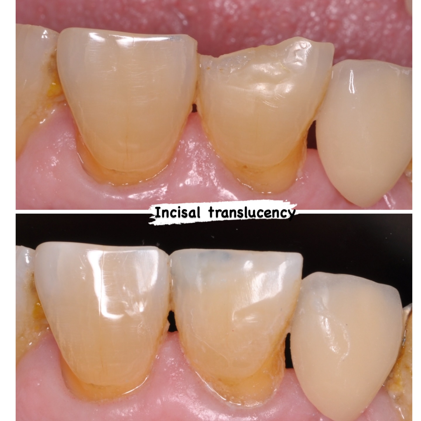 Edge bonding with layered composites. 5 minute repair #nhs #treat #treatment #endowarrior #endodontia #rootcanaltreatment #rootcanaltherapy #endobelly #waves #waveonegold #saveteeth #endospecialist #treatyourself #simplicity #dentaltreatment #compositebonding #dentistry #endodontics #dentaltreatment #difficultendo #dentistrylife #dentistrylove #edgebonding